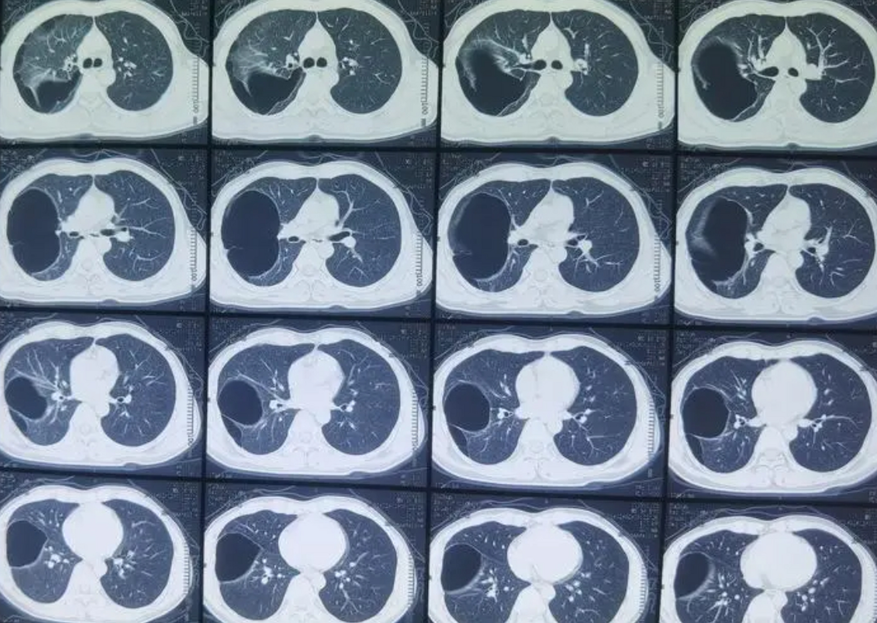 比如你是这个急性的支气管肺炎,然后你炎症的部位