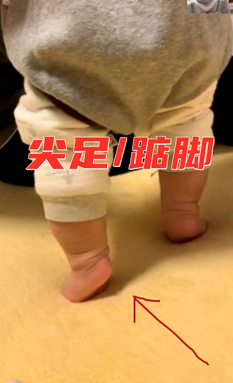 肌张力正常,踝背屈角度正常,一岁以内宝宝生理学尖足是没有问题的