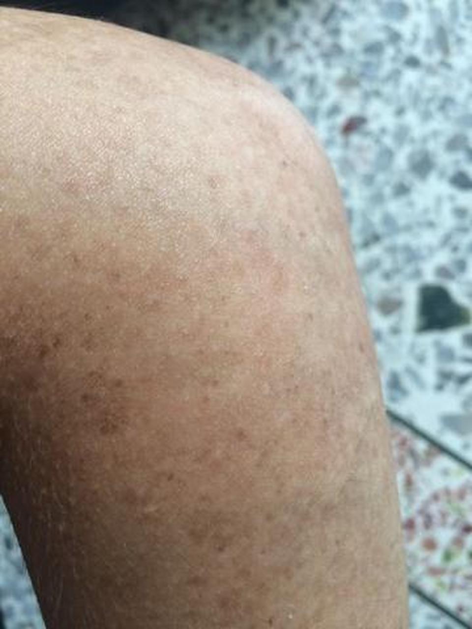 皮肤有黑色素沉淀怎么办  皮肤有黑色素沉淀怎么办,对于想要去除黑