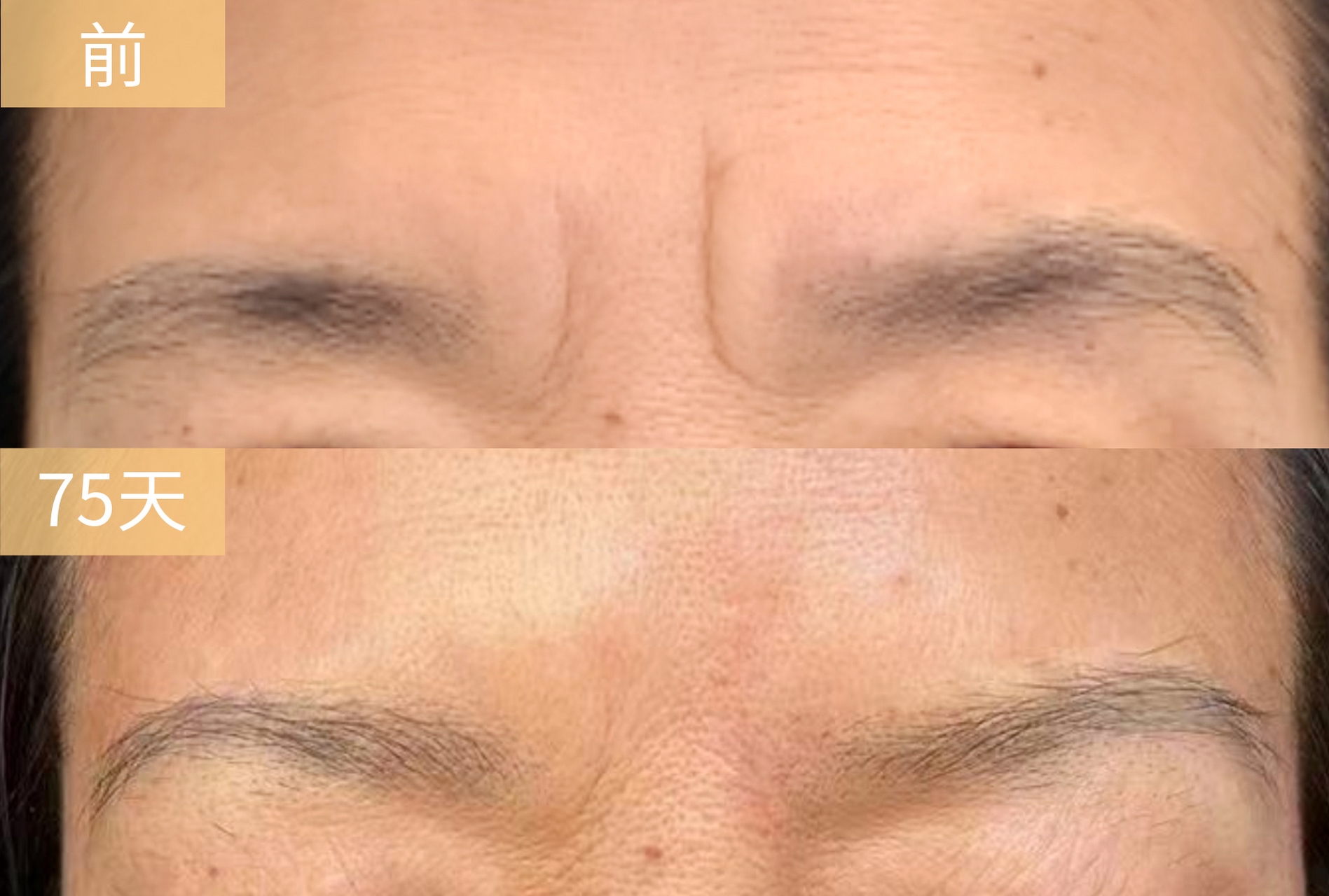 像这种重度川字纹是一种静态纹,即使你不做任何表情,也会存在的皱纹.