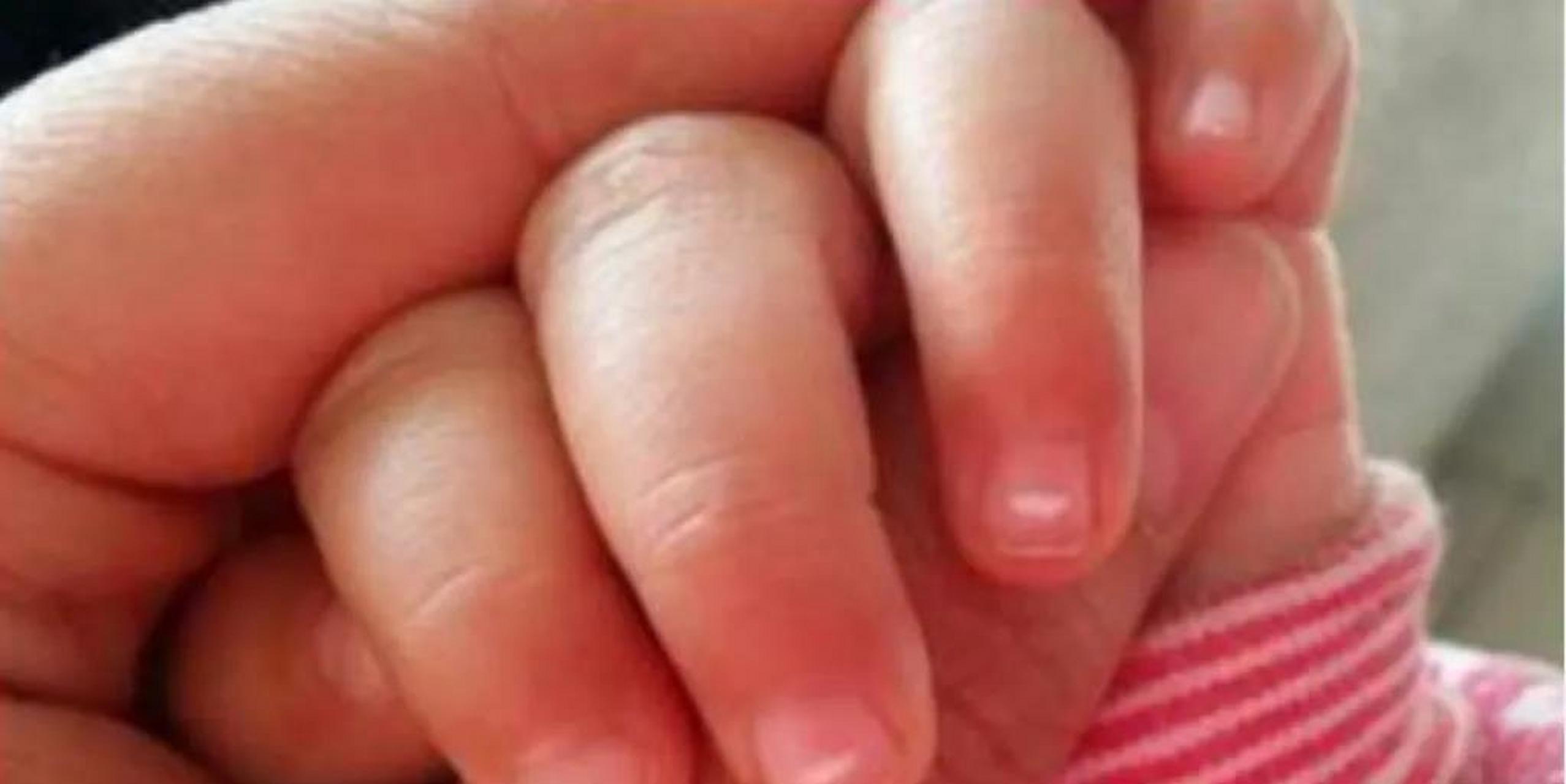 指甲有竖纹就是不健康吗#  4个月宝宝的指甲坑坑洼洼,有点瘪,指甲缮 