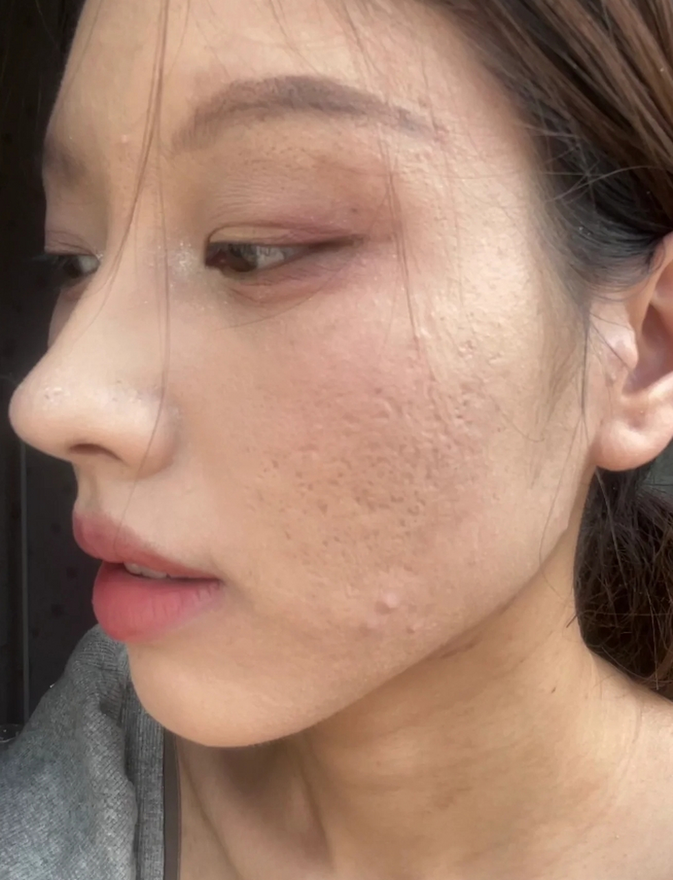 医美科普挑战赛#  痘坑,或称为痘疤坑,是许多人在经历青春期痘痘问题