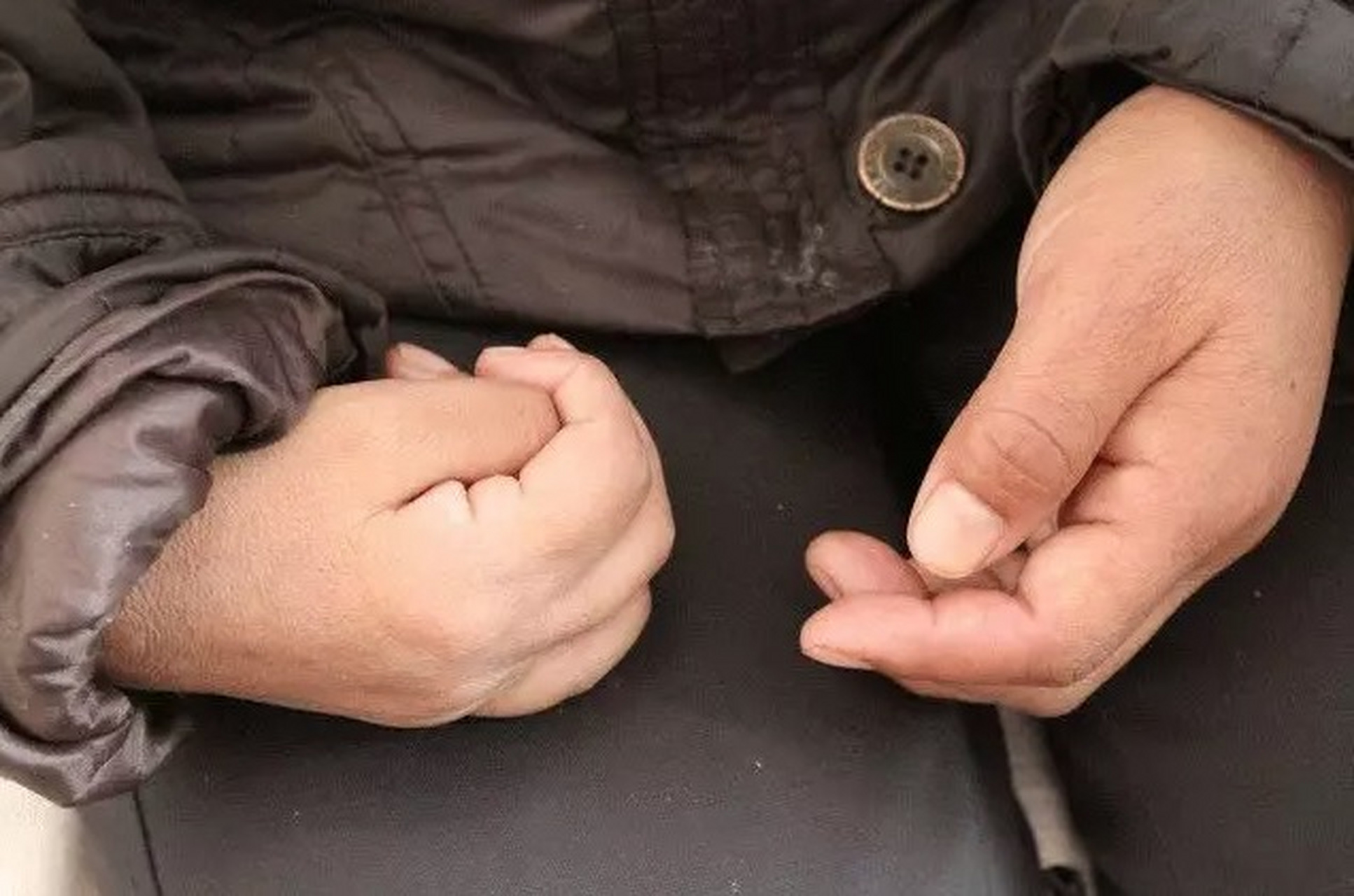 脑梗后,手指的肌张力很高怎么办?