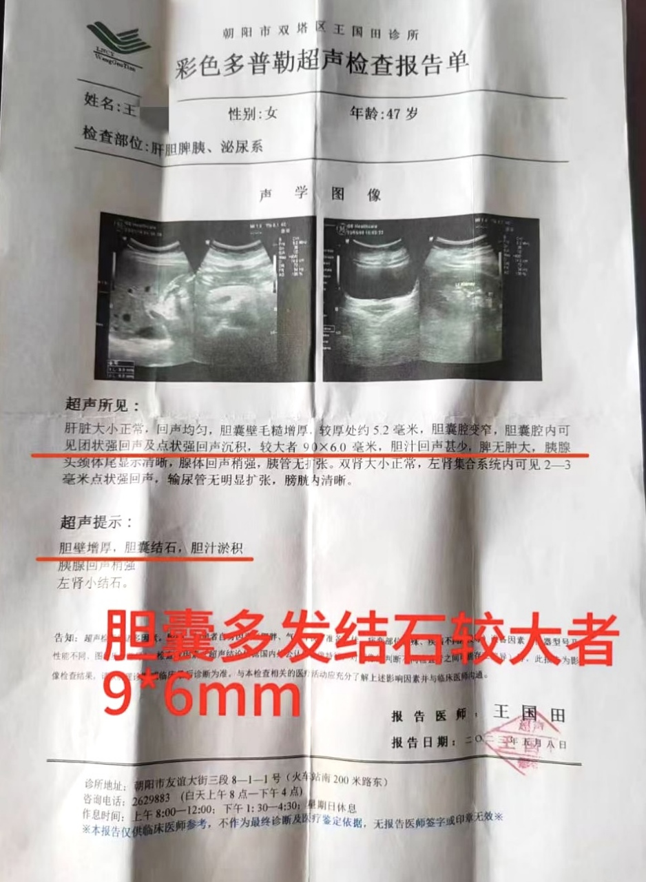 用药2个月症状逐步减轻 复查报告显示:胆囊结石消失!