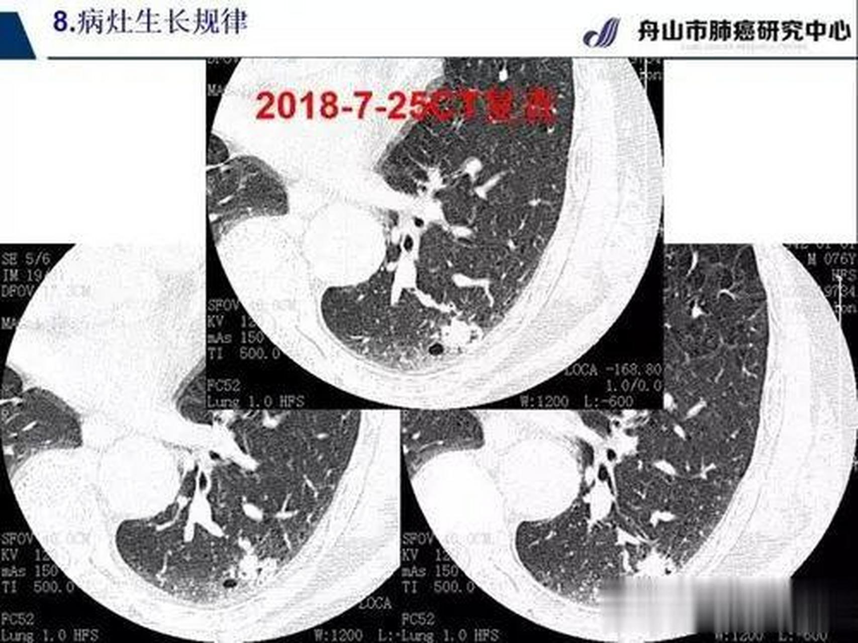 肺纤维灶:简单说:肺纤维灶即为肺纤维化.