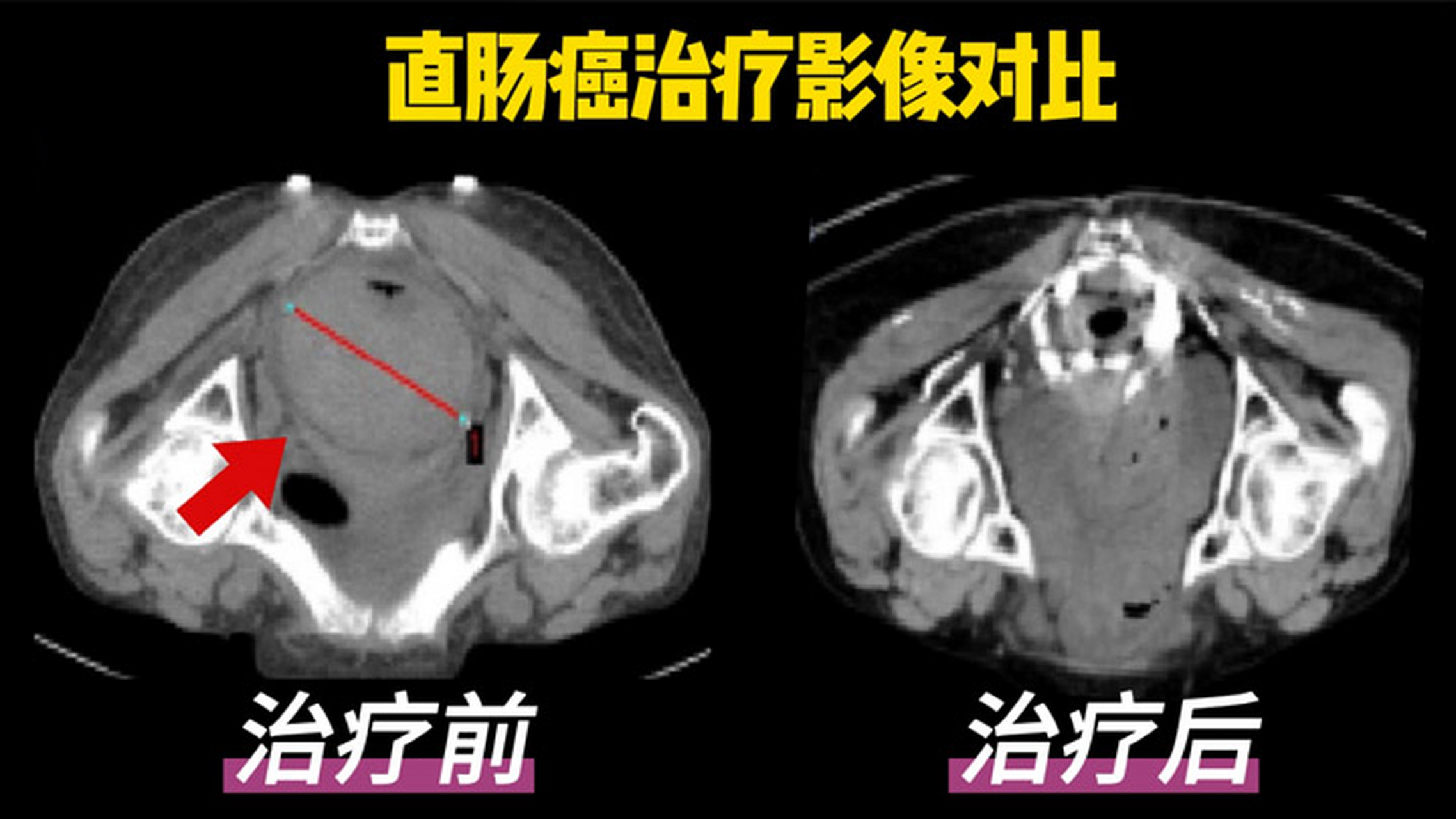 这位50岁直肠癌患者,2021年便血半年余,在当地医院进行了腹腔镜辅助