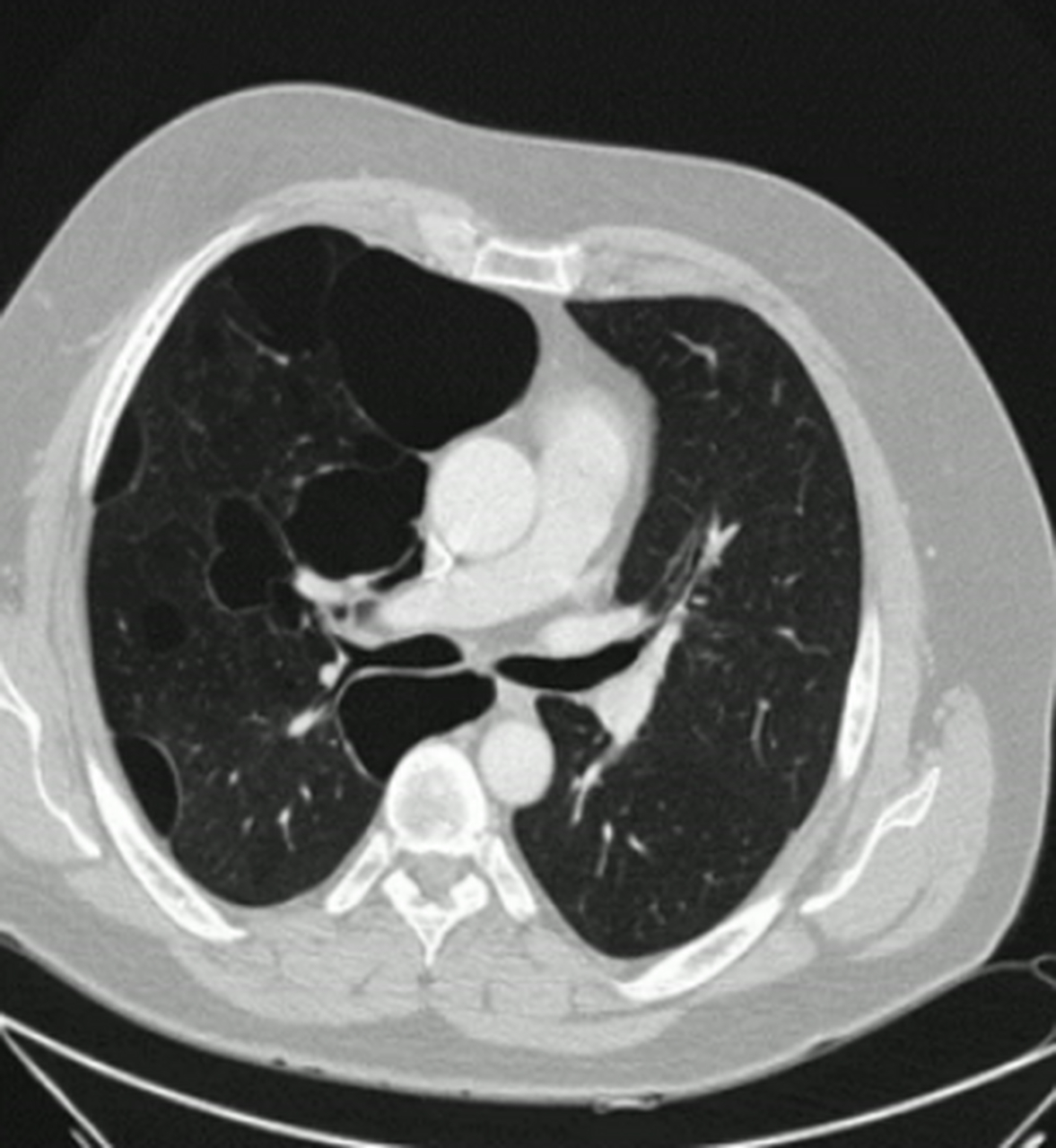 这些破裂的部分形成了气囊,称为肺大泡.