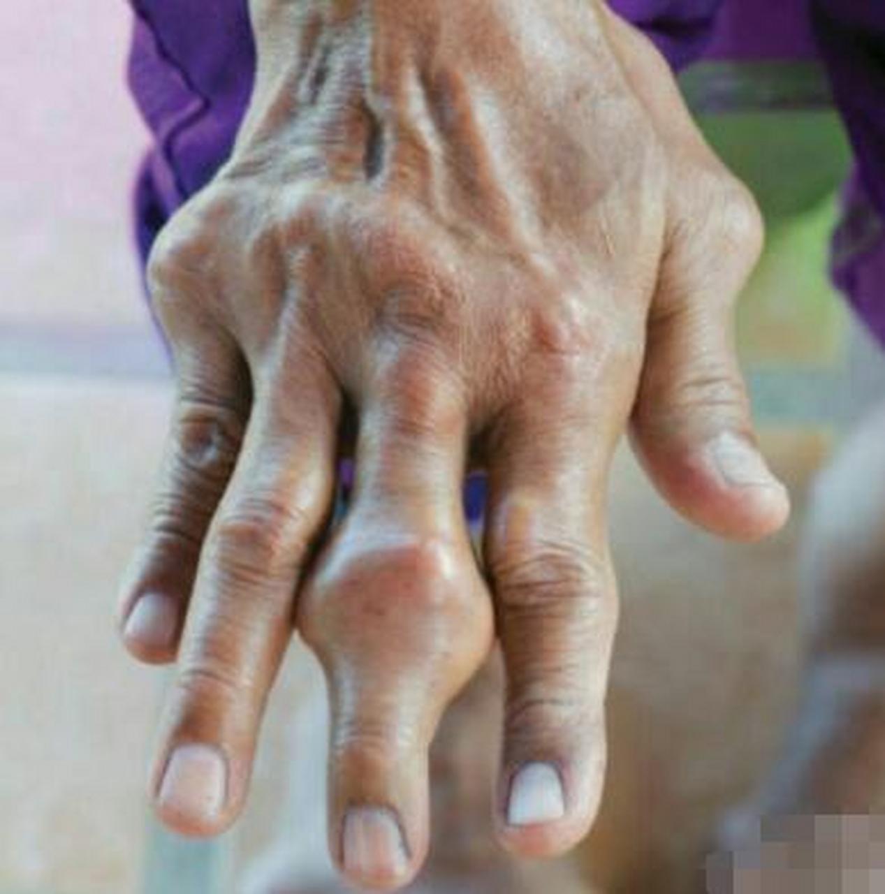 【类风湿性关节炎】 天鹅颈,纽扣花,类风湿性关节炎.