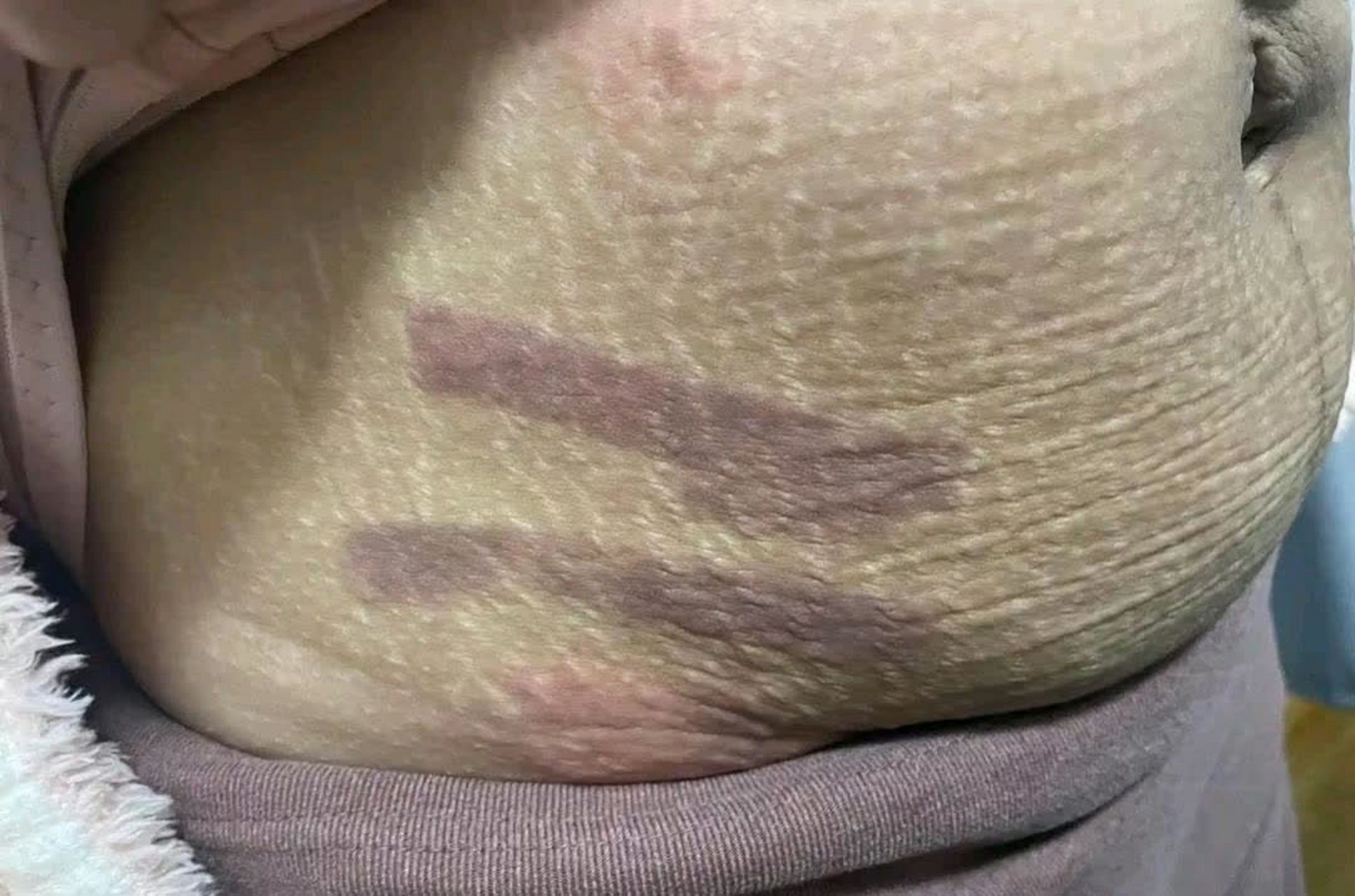 产后肚子是这样的. 您有什么改进的建议吗?  #我们都爱八卦#[滑稽]