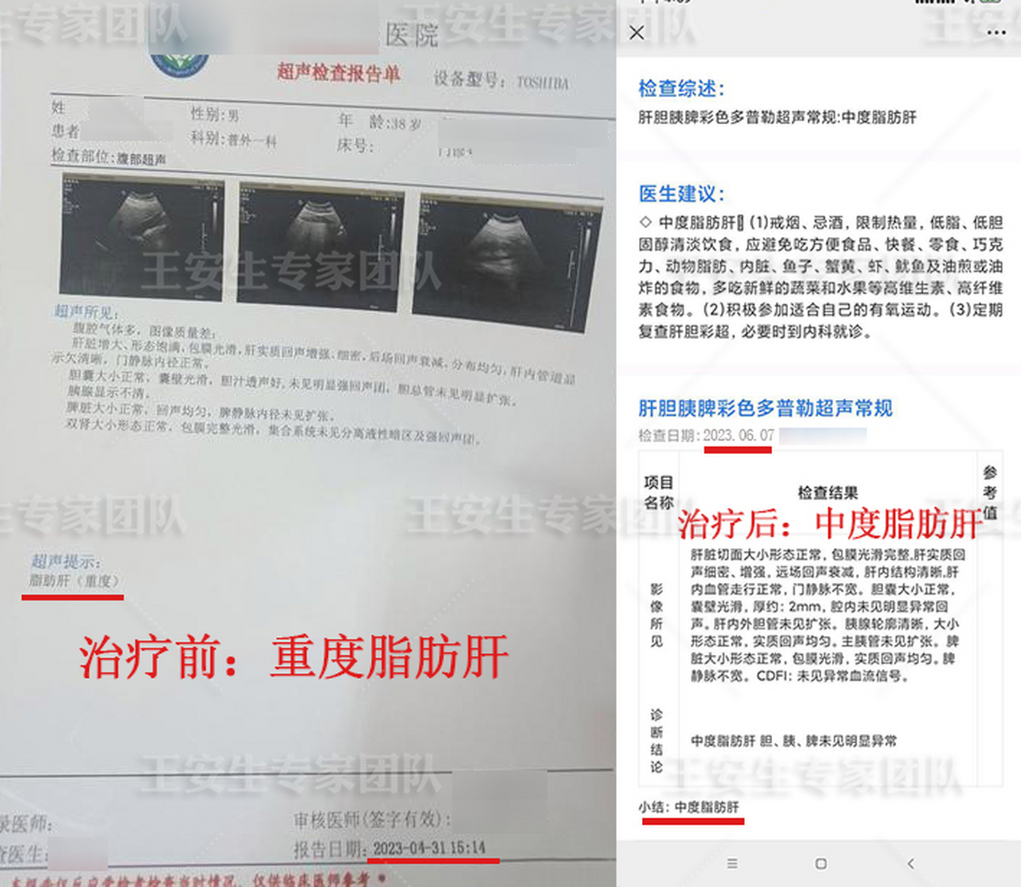 1个月【重度脂肪肝】变中度脂肪肝  宋先生脂肪肝四五年一直没有重视