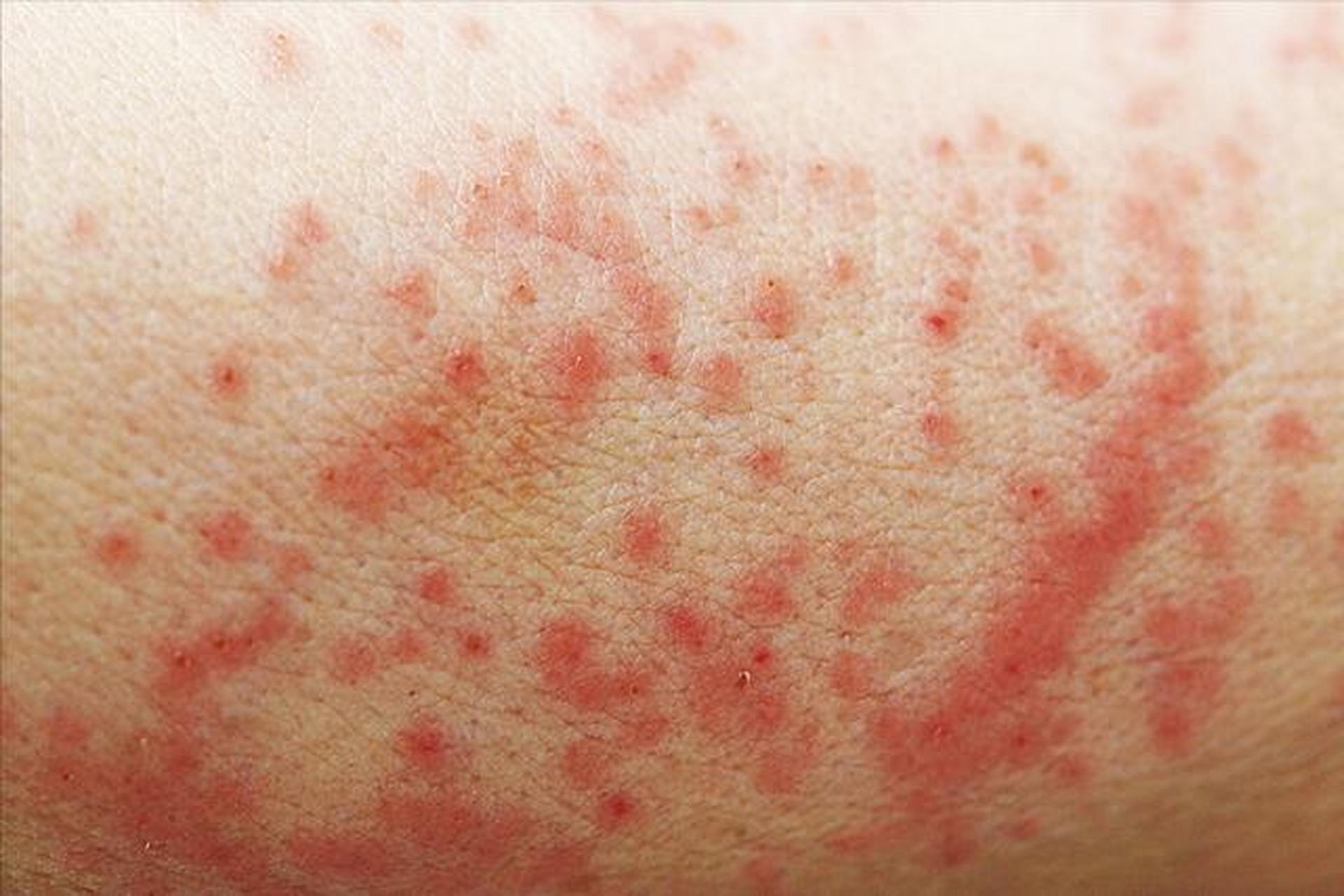 中医辨证分型湿疹,到底是湿热还是寒湿?