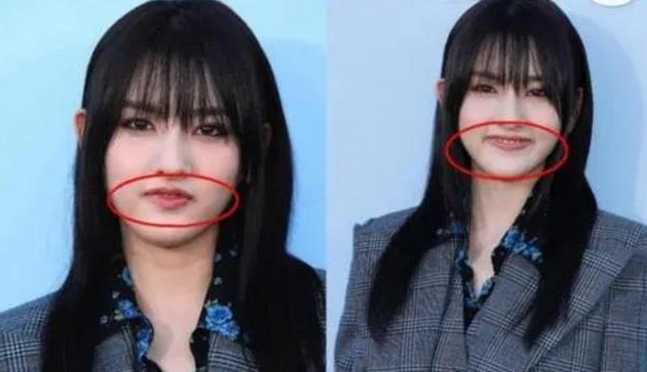 为什么催吐脸骨会变形?