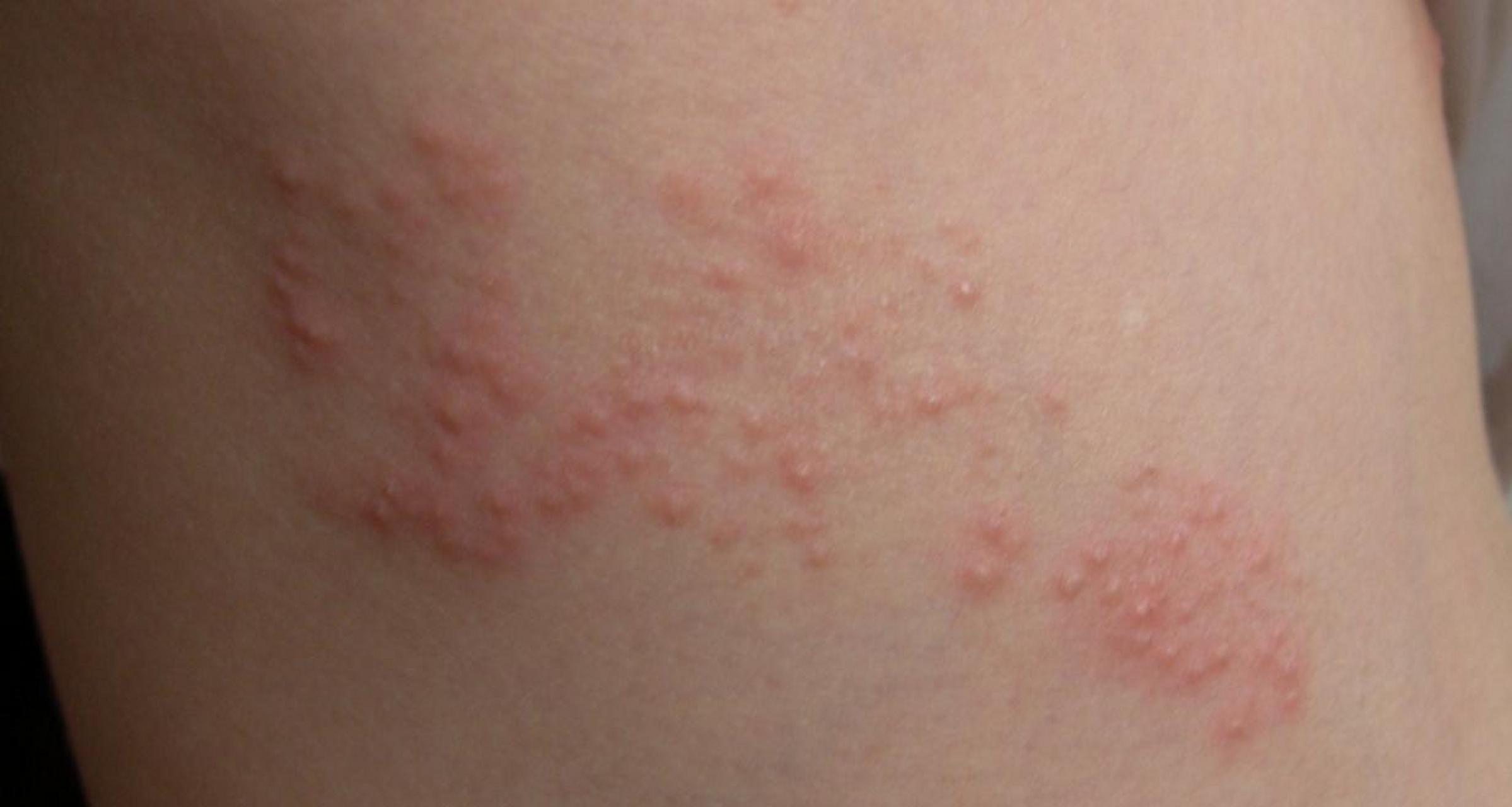 缠腰蛇##缠腰龙带状疱疹,治疗方法三建议 门诊上来了一位患者,腰部