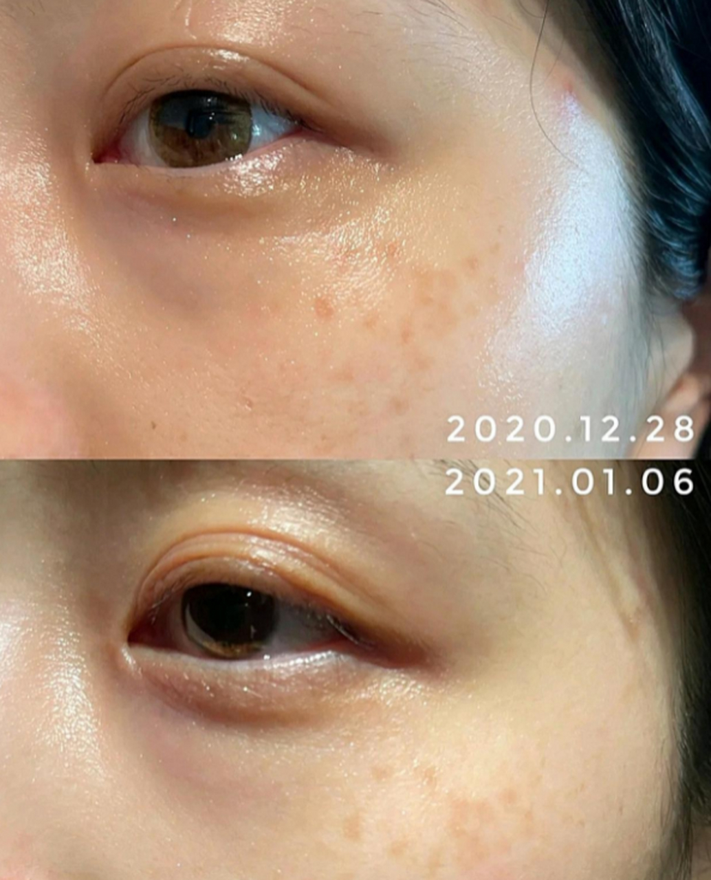 超皮秒祛斑真的有效果么?