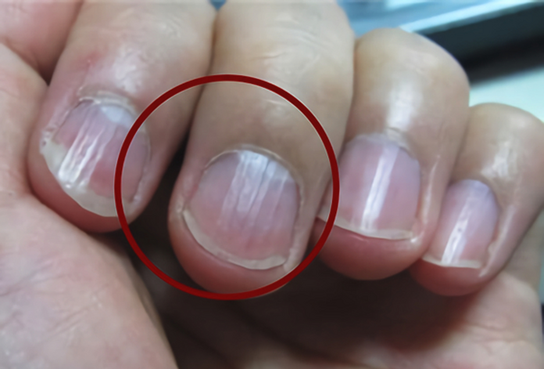 你的肝好不好,看看这个手指就知道!