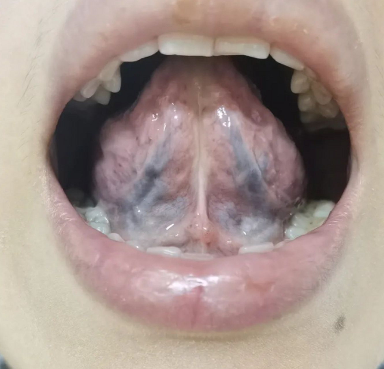 舌质淡白,半透明感  舌苔铺满舌体胖大,舌中舌根,苔白,凹陷