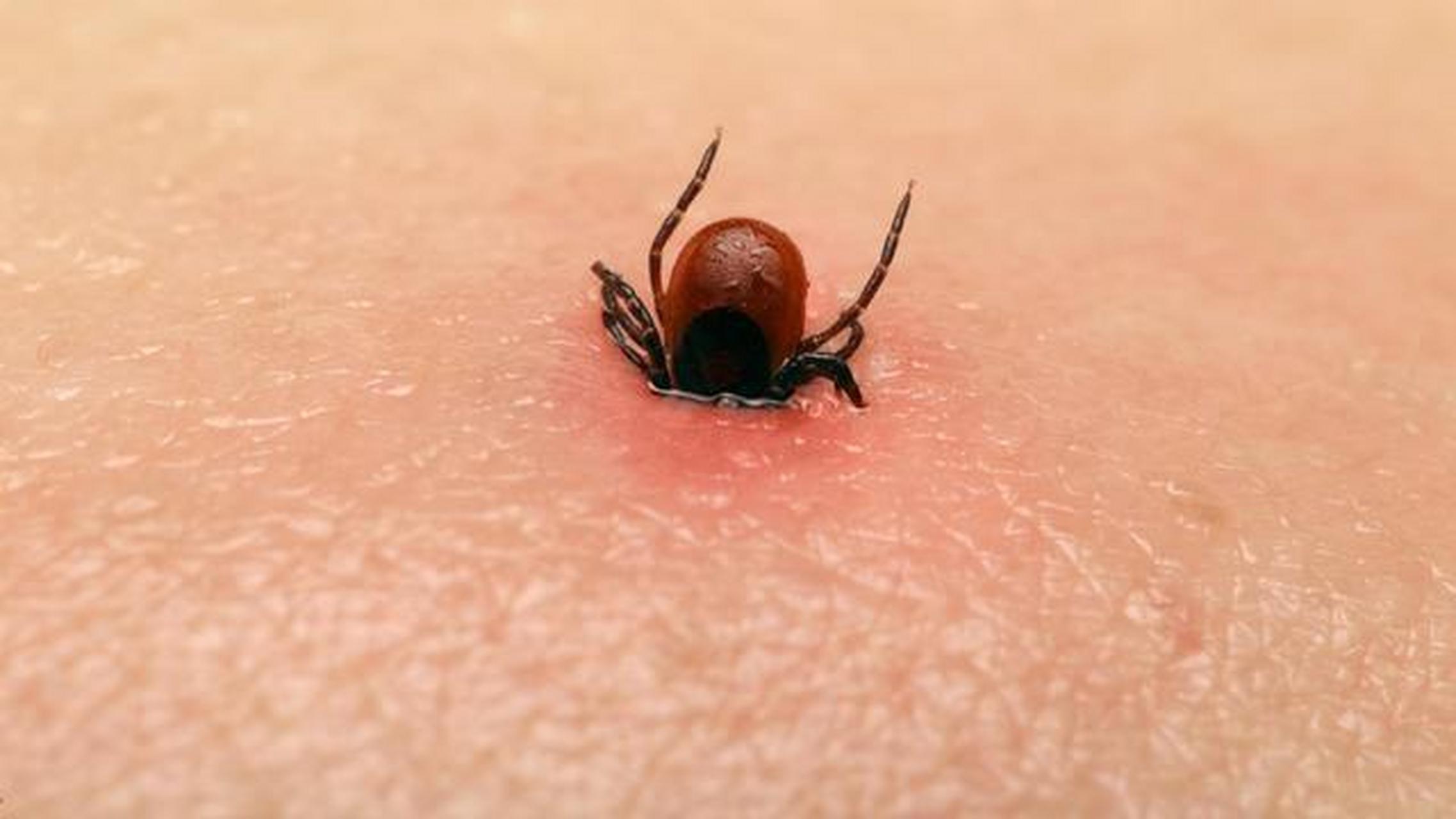 一个七十多岁的老人因被蜱虫叮咬感染新型布尼亚病毒去世,其四名家人