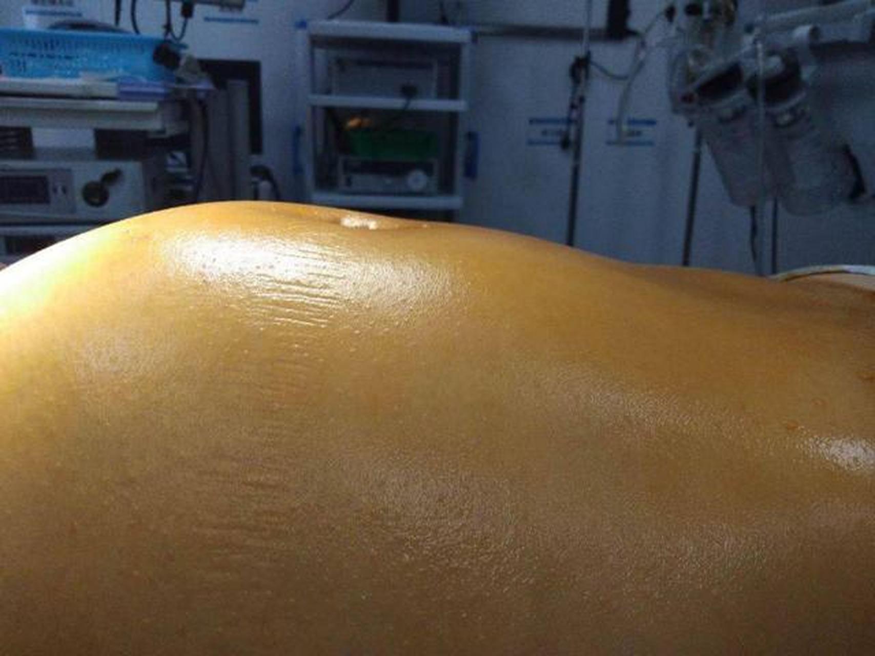 肝硬化腹水的6大征兆,一个方法消除腹水 1.