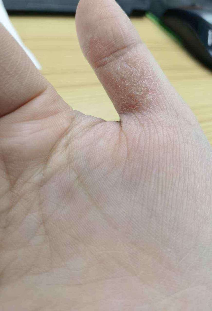 【提问】女,27岁,大拇指这个位置一直都很干,干完就起皮然后裂开,有