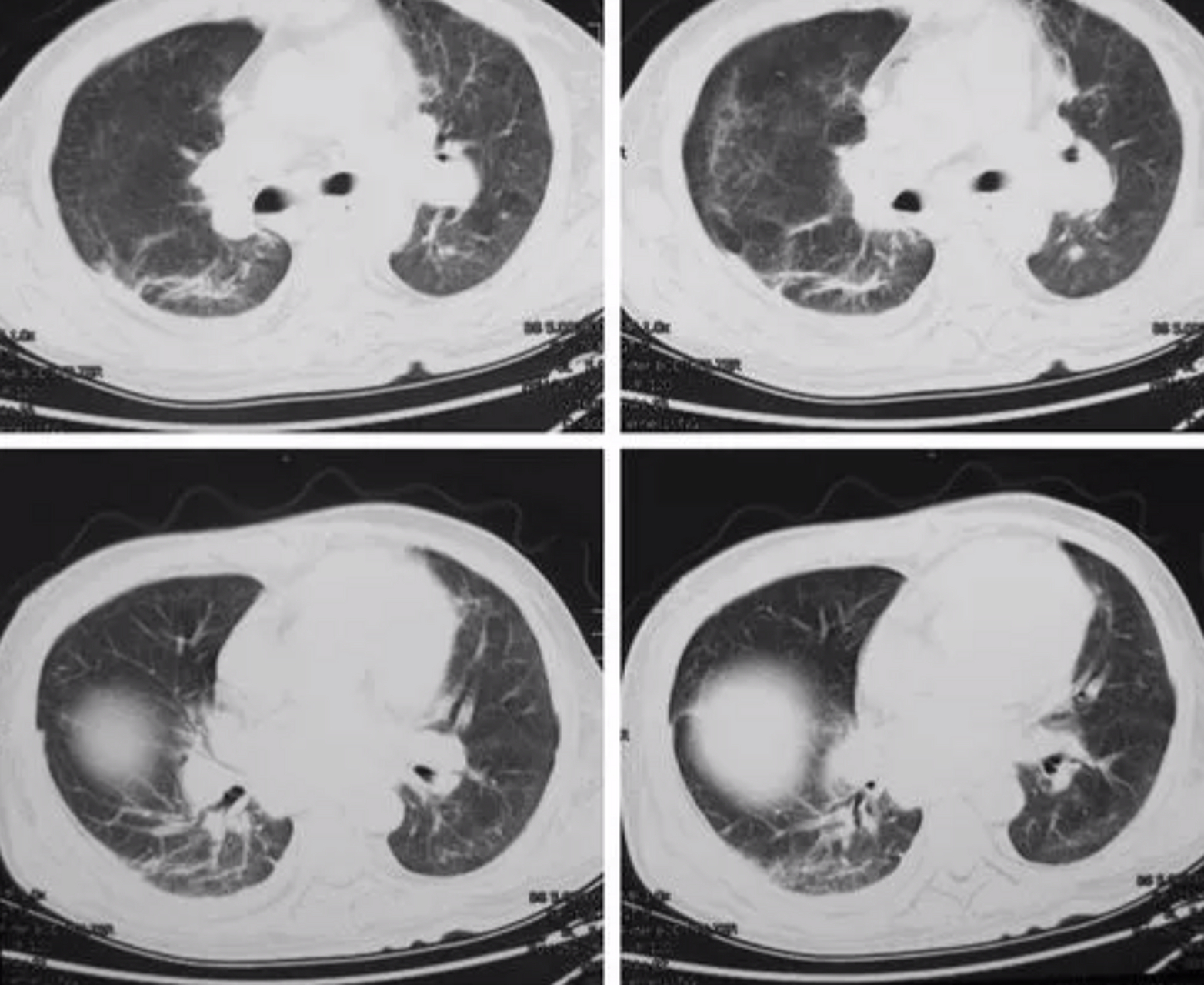 怎么处理?  这个"双肺可见少许索条影"啊