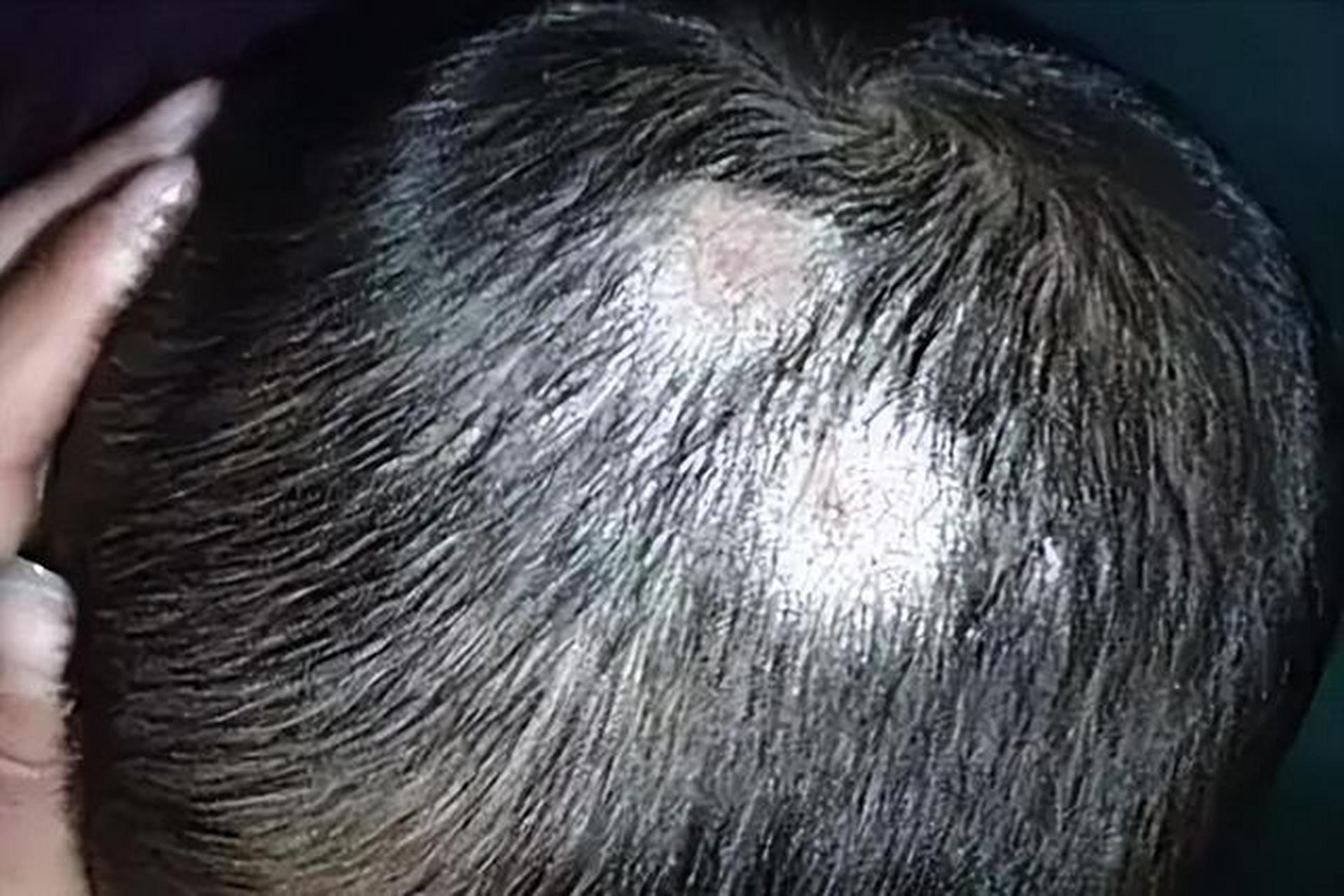 头癣分很多类型,最常见的3型是白癣,黑点癣和脓癣,其中脓癣会引起