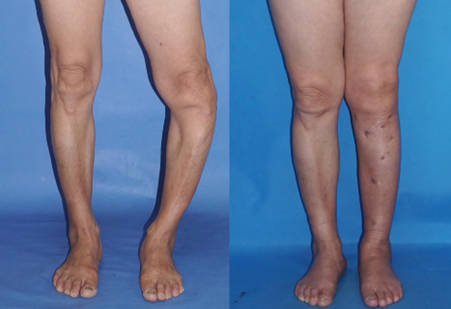 来我这看关节炎的,很多是年轻时候0型腿,x型腿,膝外翻,膝内翻没有治疗