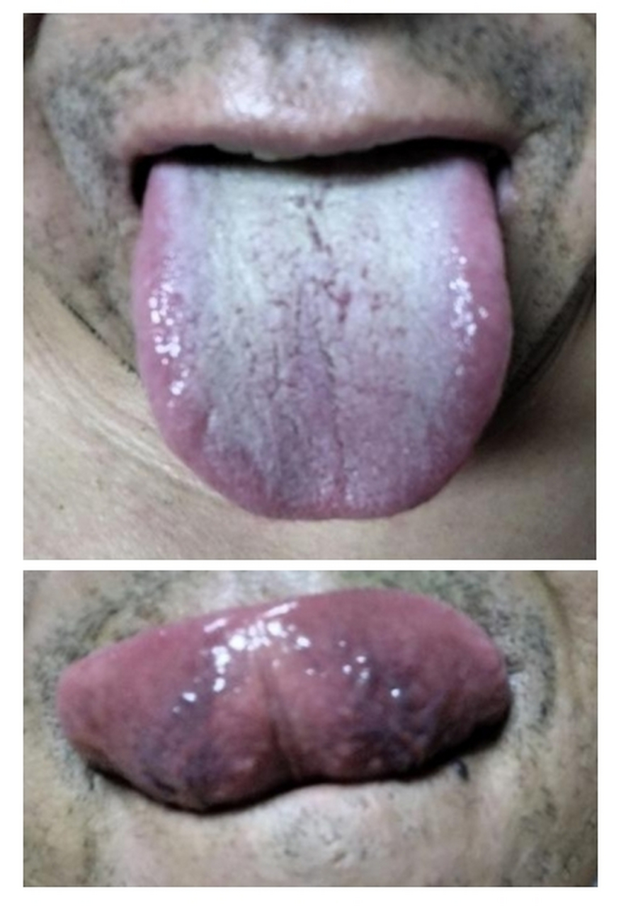 舌下青筋血管偏细,鼓胀,分叉多,表现这个粉丝有气虚,气滞血瘀