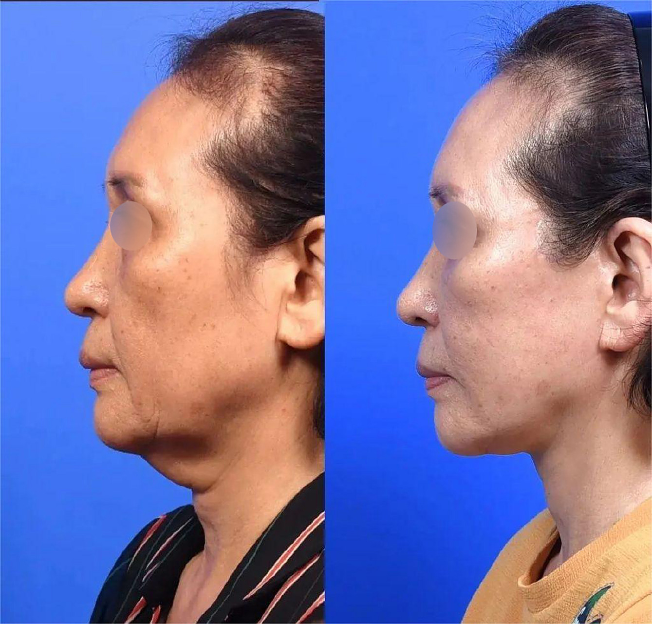 如果出现这种情况,颈部小切口拉皮,改善"火鸡脖",更适合出现中重度