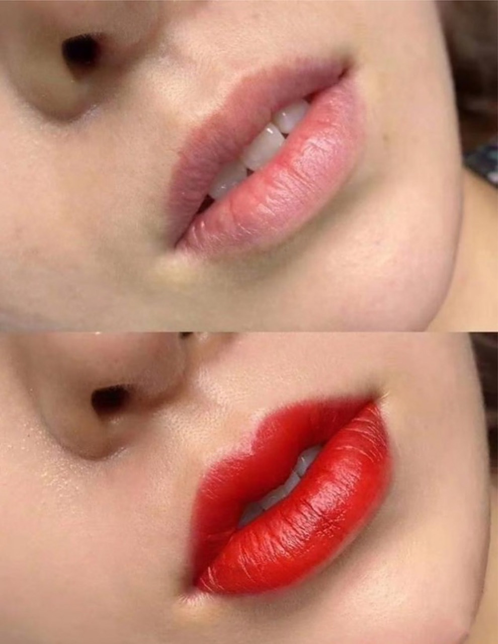 纹唇是一种常见的美容手术,通过在唇部周围的皮肤上注射玻尿酸或