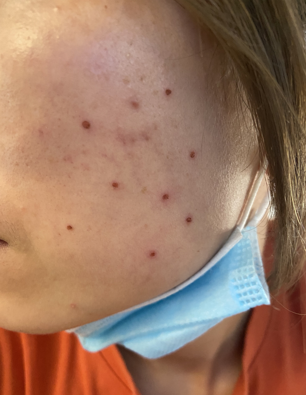 激光点痣不小心把结痂碰掉了,怎么处理?  别慌!