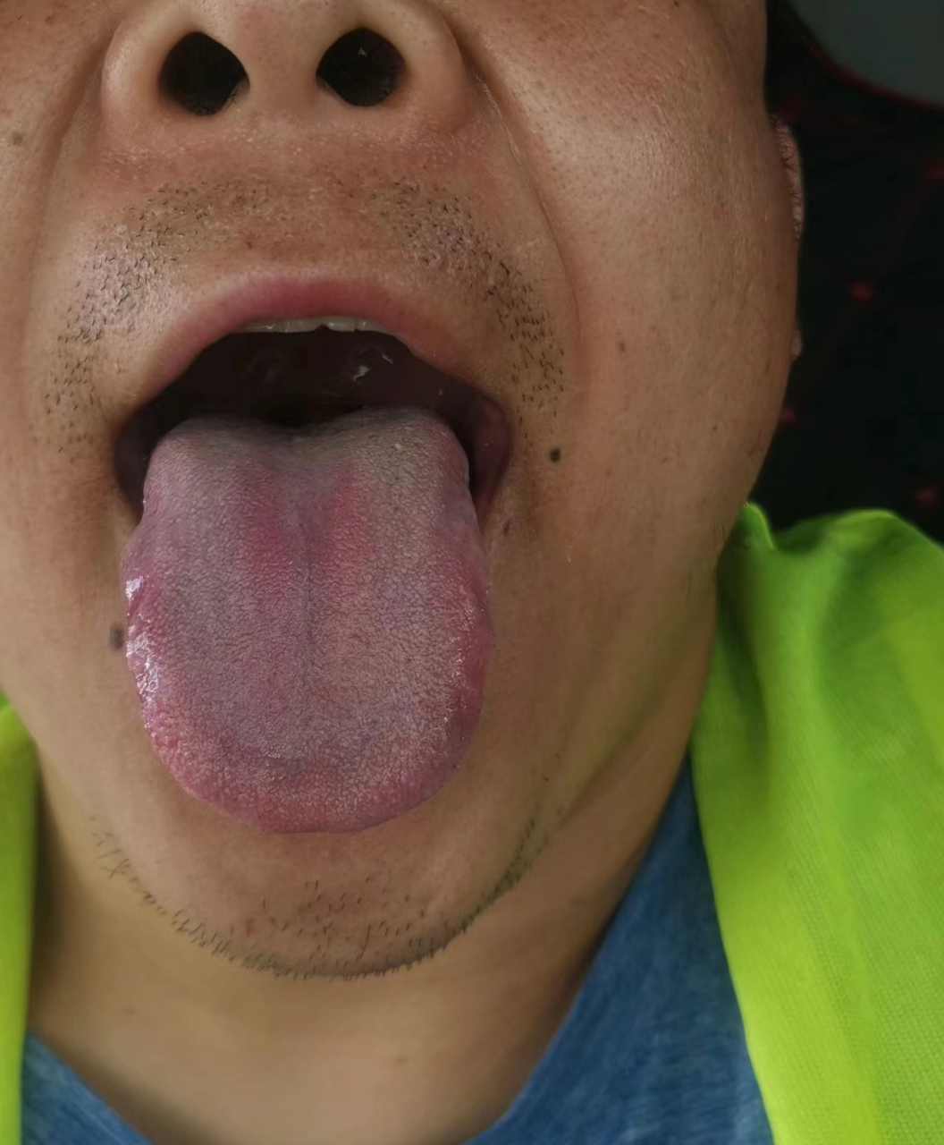 肝火旺的舌象图片图片