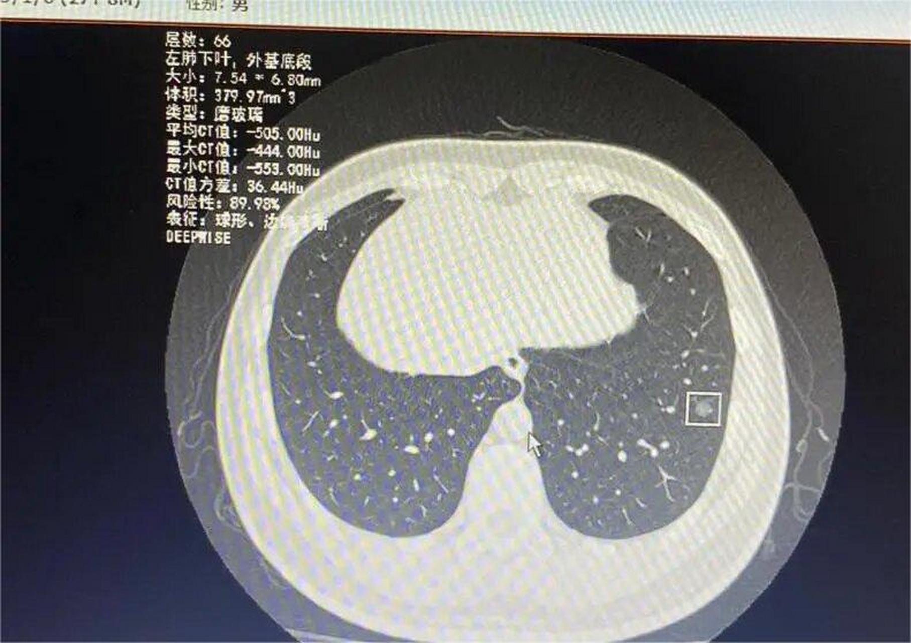 小于10mm的肺磨玻璃结节也可能是浸润性腺癌!