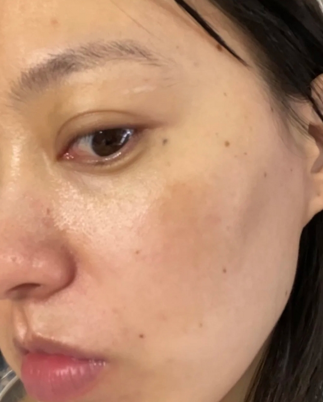 脸上的黑色素沉积是许多人关注的问题,它可能导致肤色不均匀,给人一种