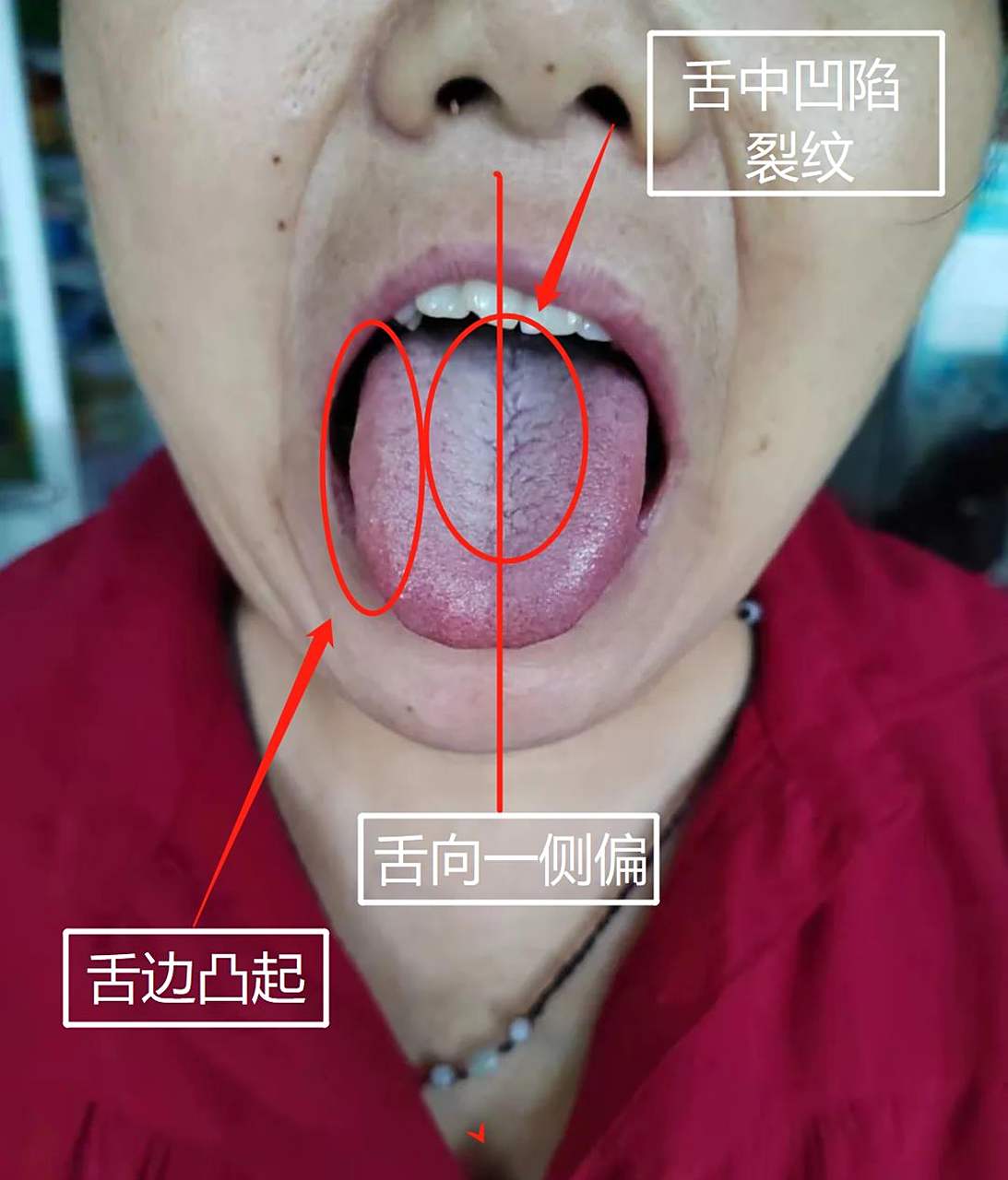 像这一个舌头,就要警惕脑梗问题了!