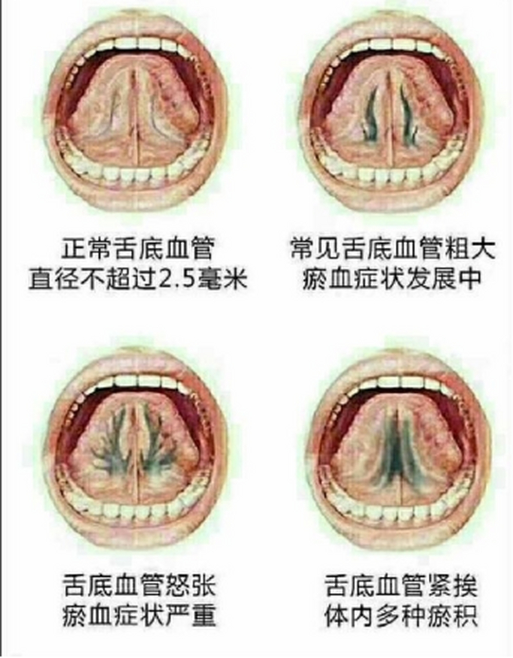 舌头有瘀点瘀斑图片图片