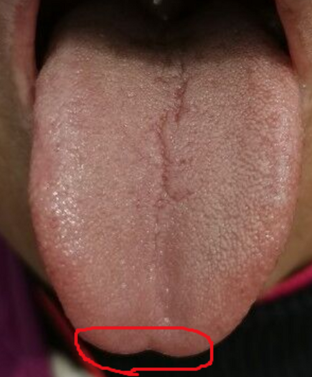 舌尖凹陷属于轻中度的凹陷,这种舌象睡眠会比较差  如果舌尖部位如果