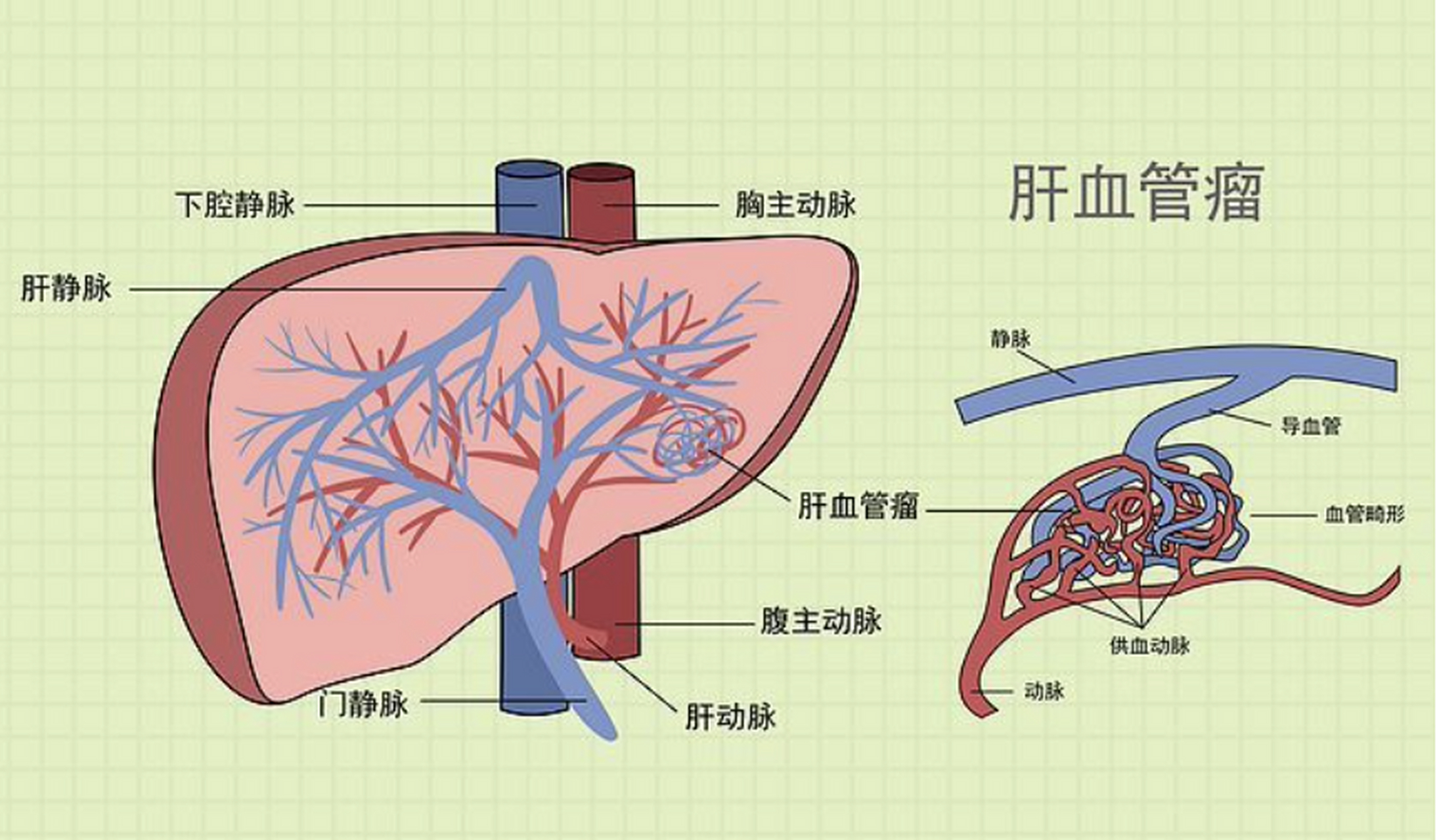 肝血管瘤症状图片