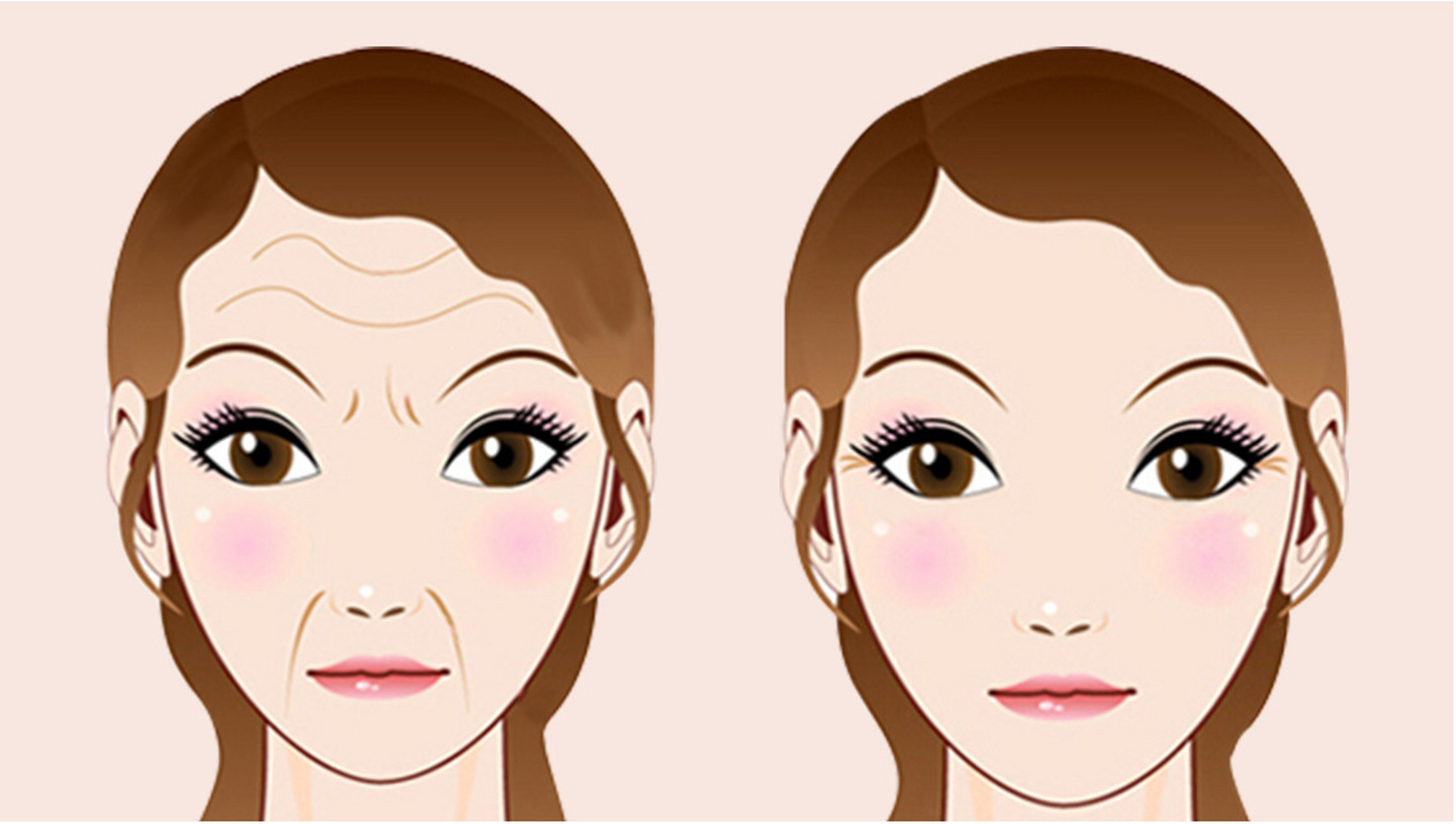 对于不严重的抬头纹可以注射玻尿酸的方式来填充,玻尿酸不仅能把