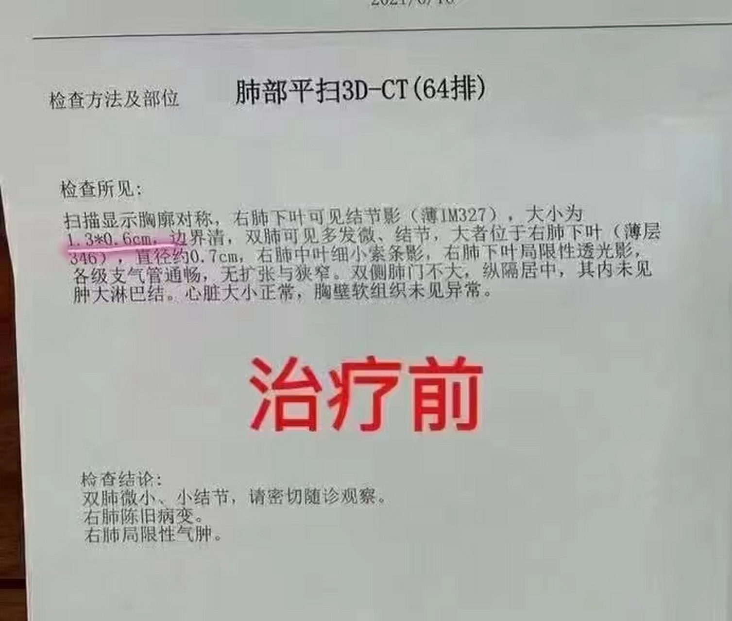 肺大泡危险吗图片