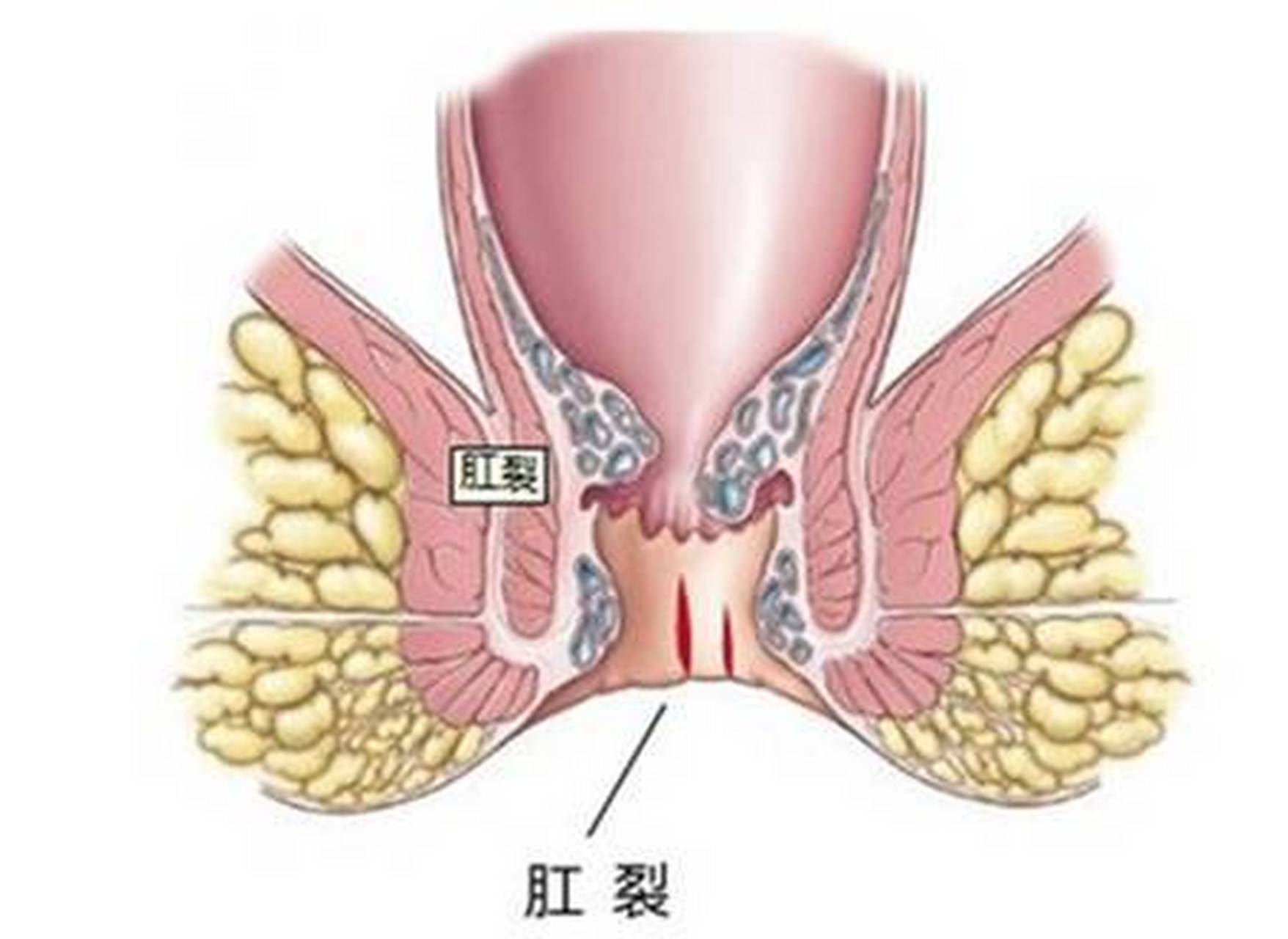 肛裂的症状图片 正常图片