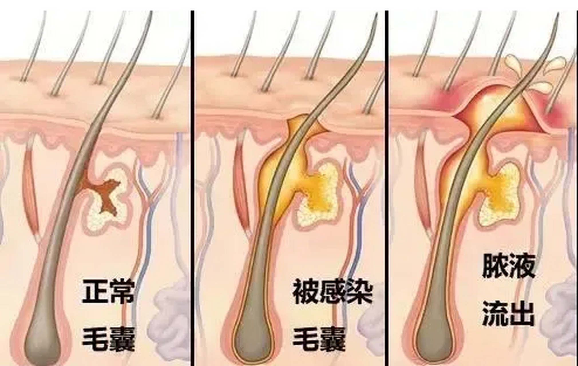 毛囊炎# 是一种常见的皮肤病,它会导致头皮或身体上出现红色,发痒,脱