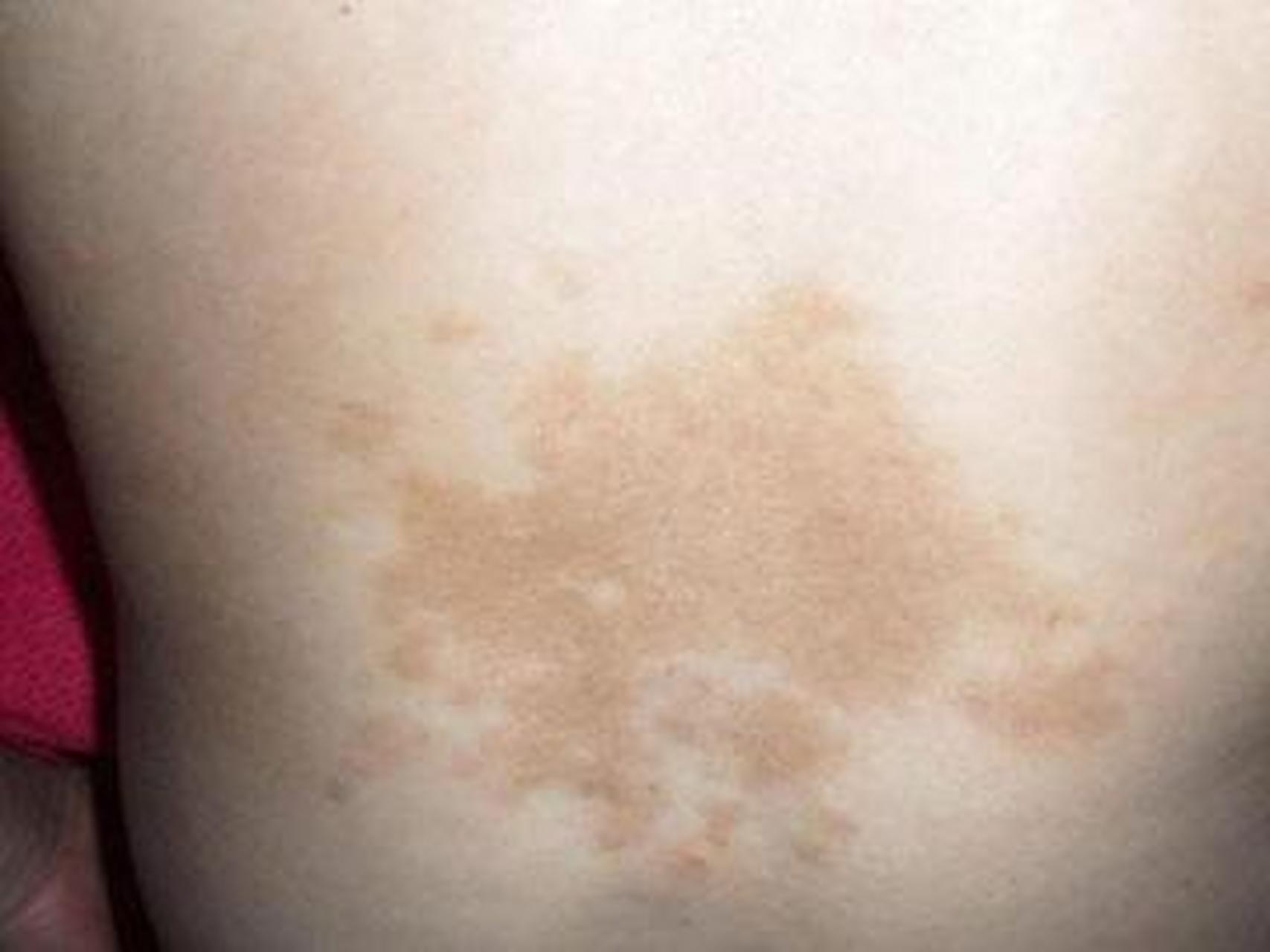 脖子上有咖啡斑怎么办  脖子上出现咖啡斑会给外貌和心理带来一定的