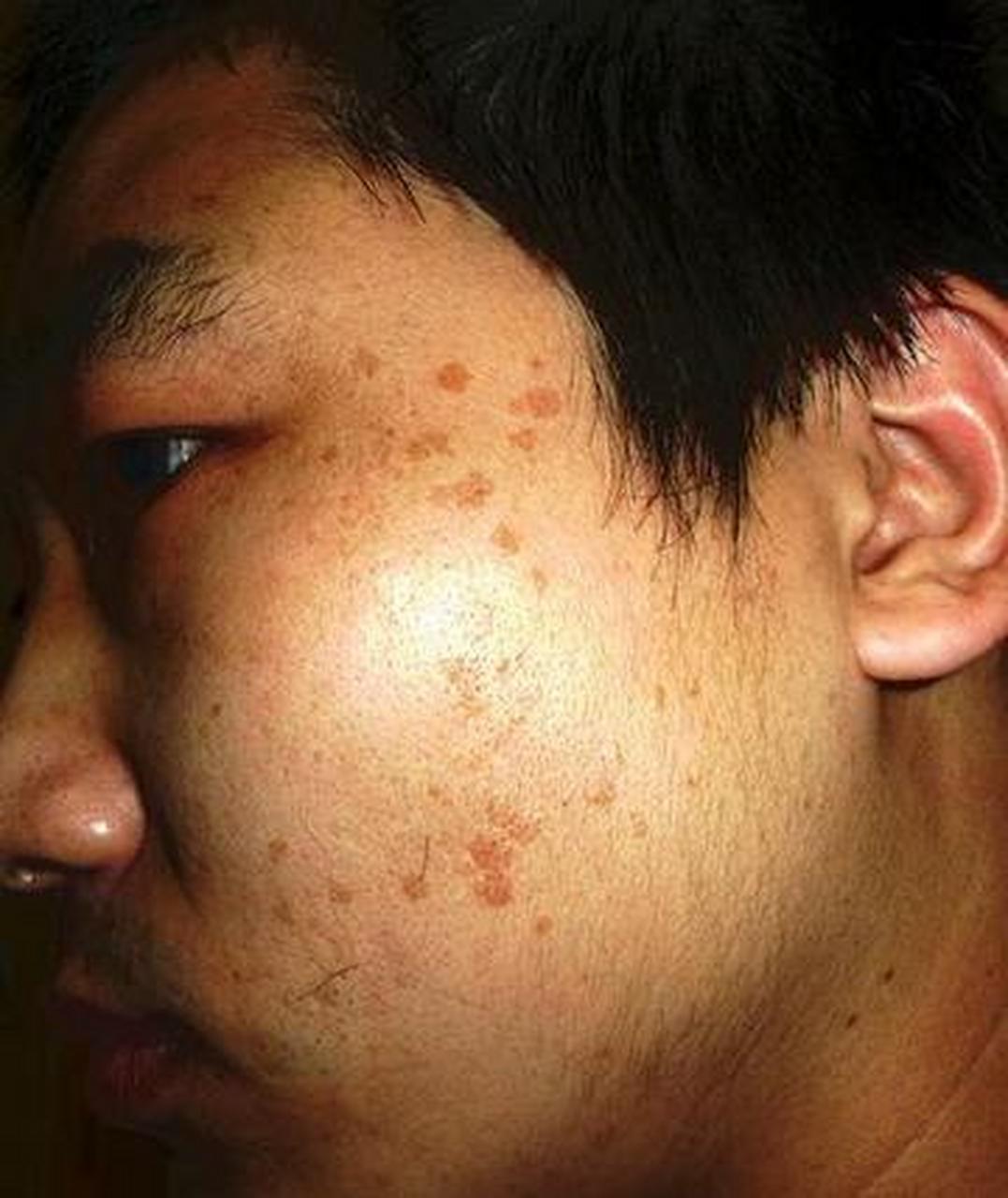男人脸上长黄褐斑怎么治疗  黄褐斑是一种常见的皮肤问题,尤其在一些