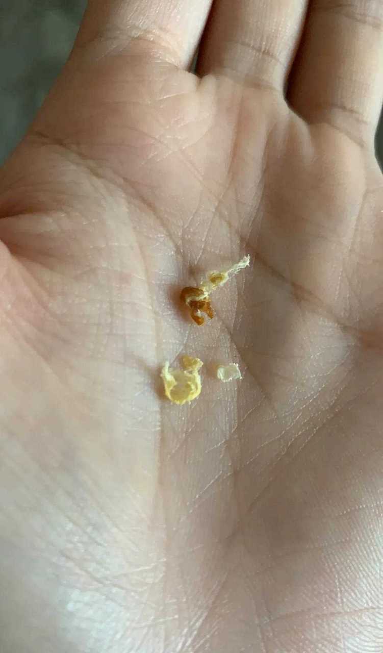 第二次给她掏耳朵,没想到真的有这么硬这么大块的耳屎,如果过几个月再