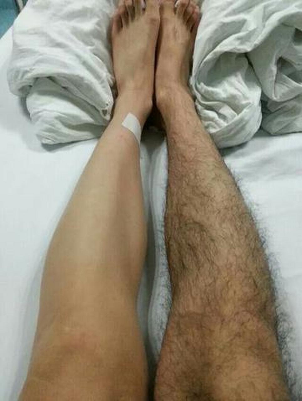 小女孩长腿毛怎么去除