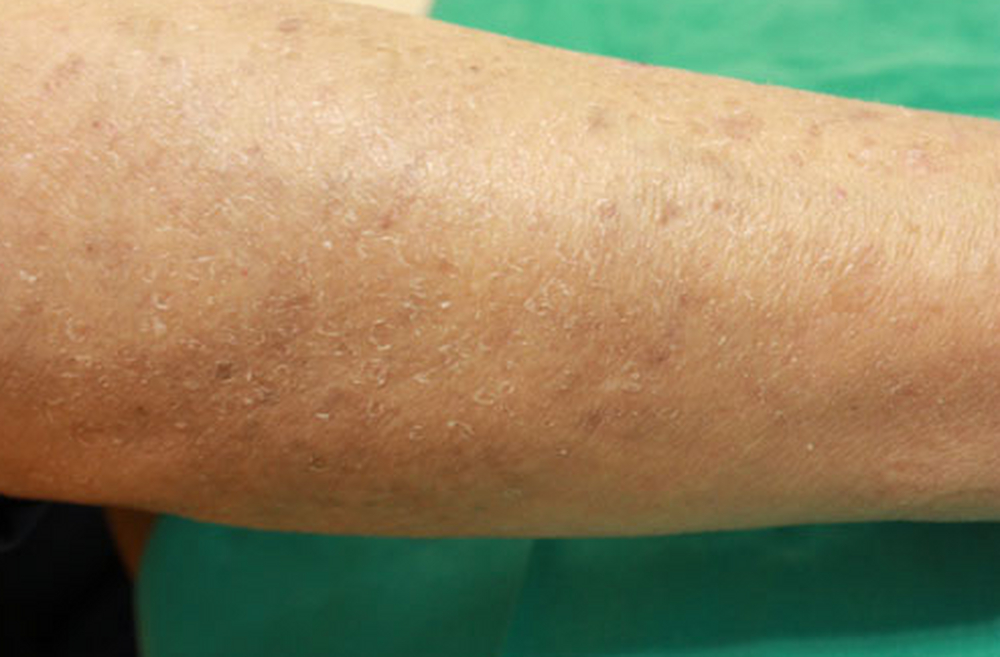 这三个表现,可能是尿毒症的前兆!