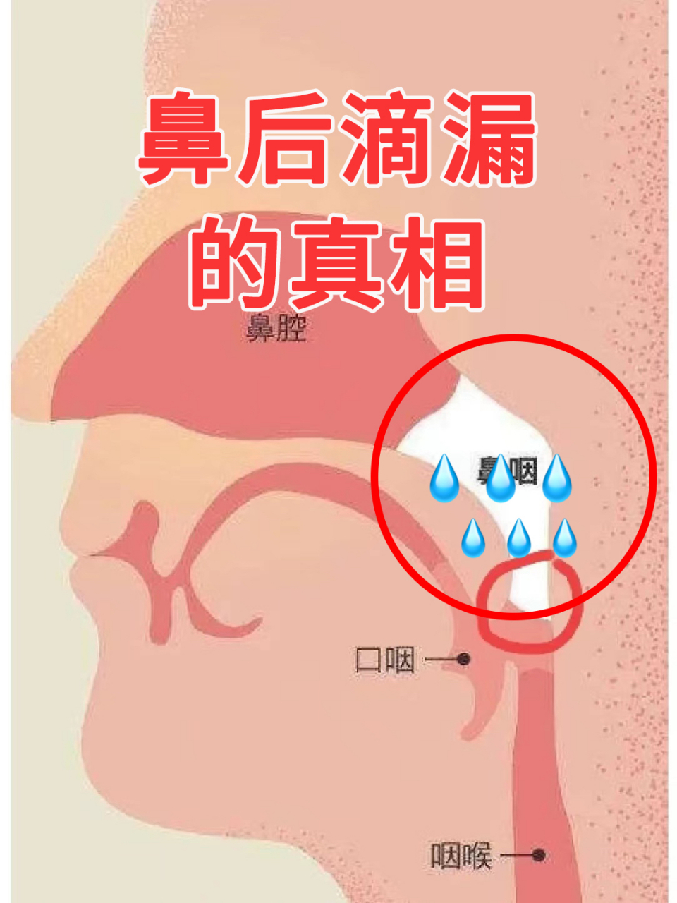 很多来就诊的鼻涕倒流患者都会告诉我,他没有鼻炎,为什么要按照鼻炎