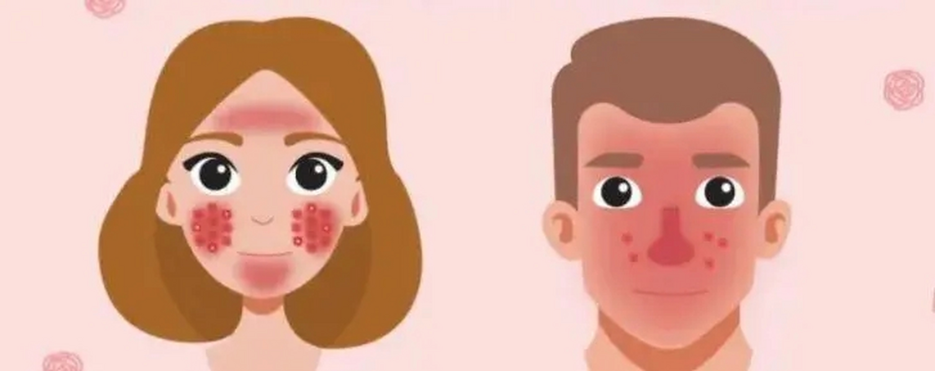 酒糟鼻有三个发展阶段#酒糟鼻# #酒糟鼻治疗# #南京治疗酒糟鼻#  红斑