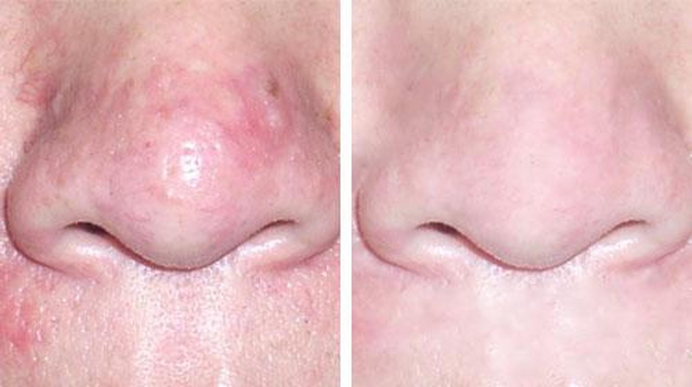 鼻子变的厚大,原因在这 鼻子厚大临床上又称为大蒜