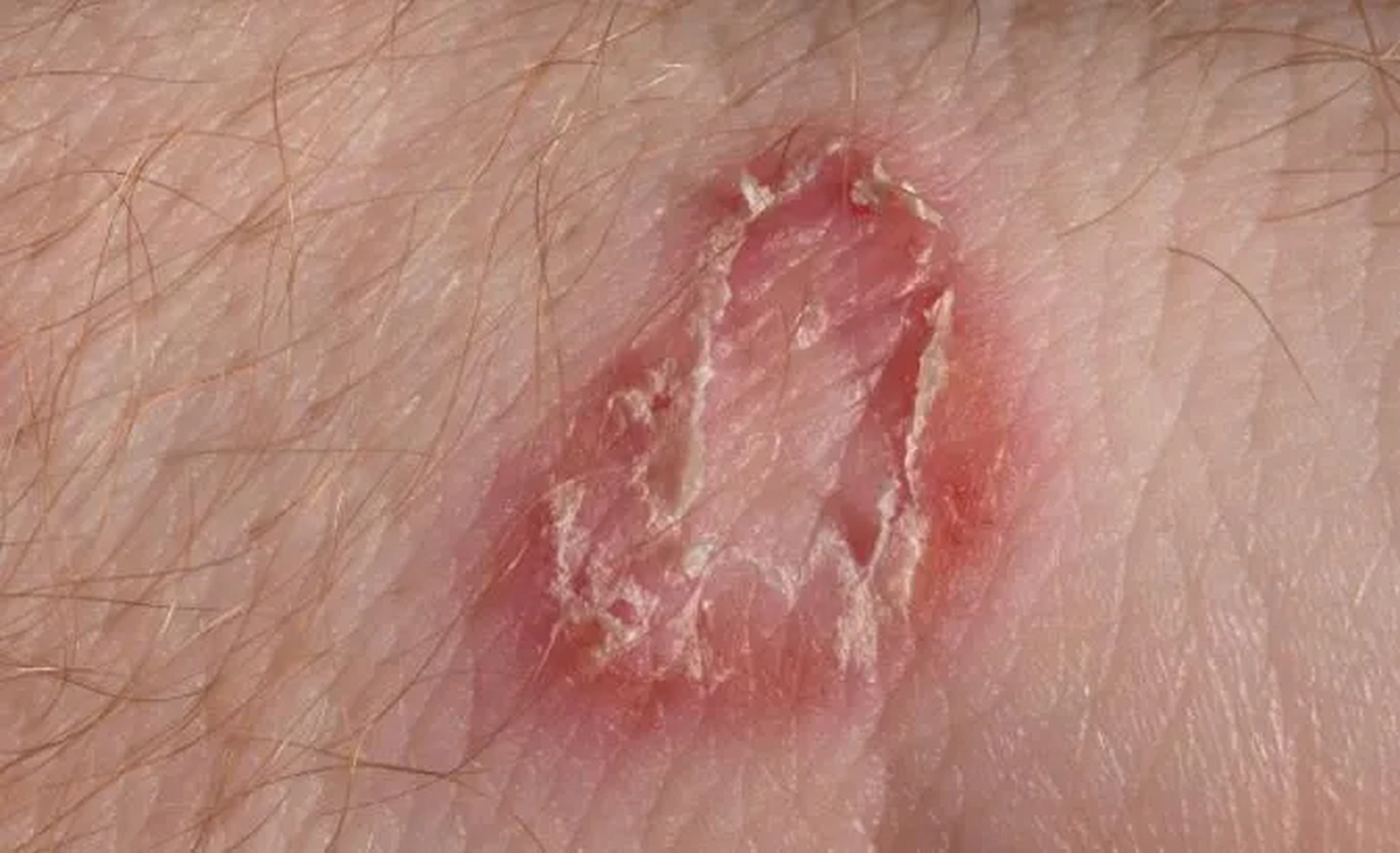 癣和皮炎湿疹经常容易搞混, 一个典型的症状有助于区分什么是癣.